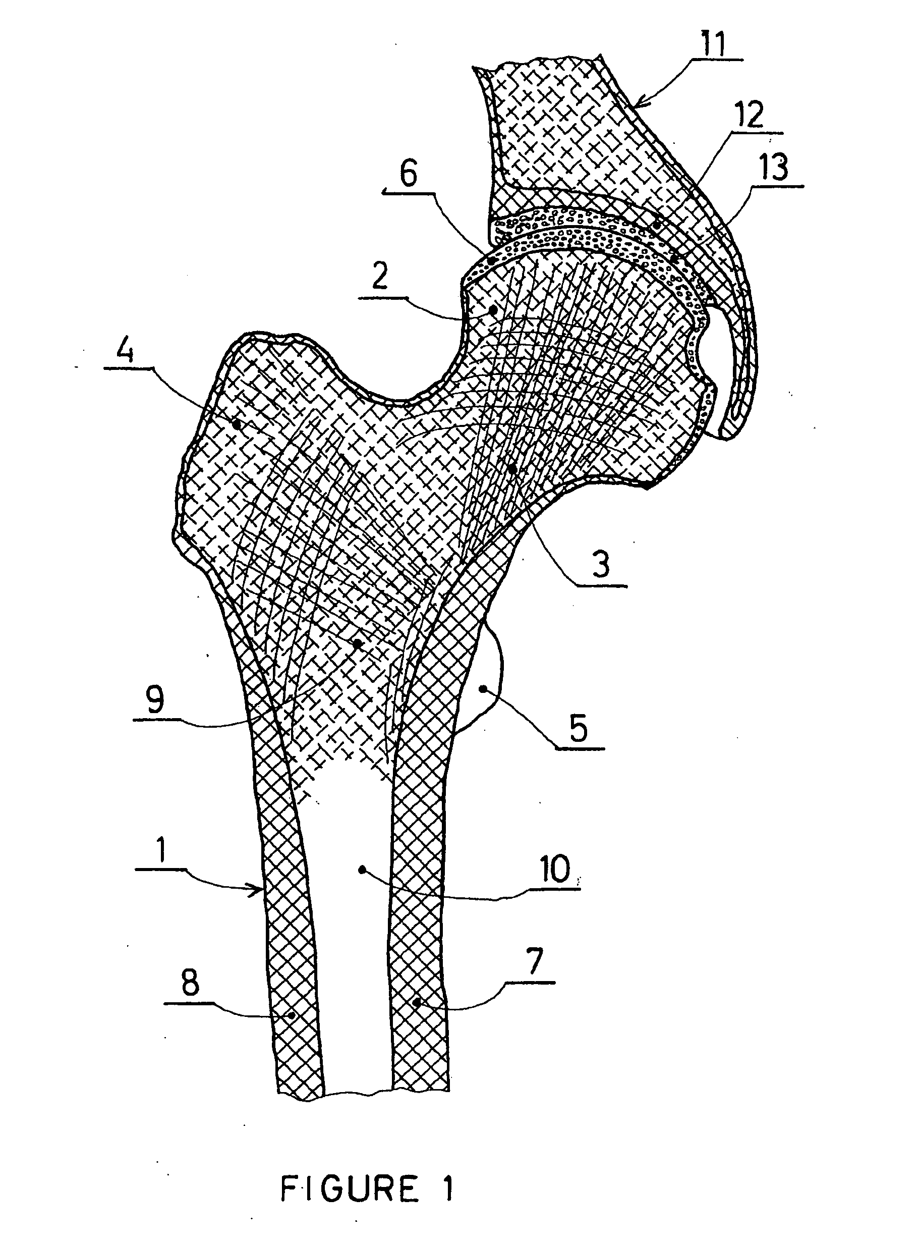 Partial hip prosthesis