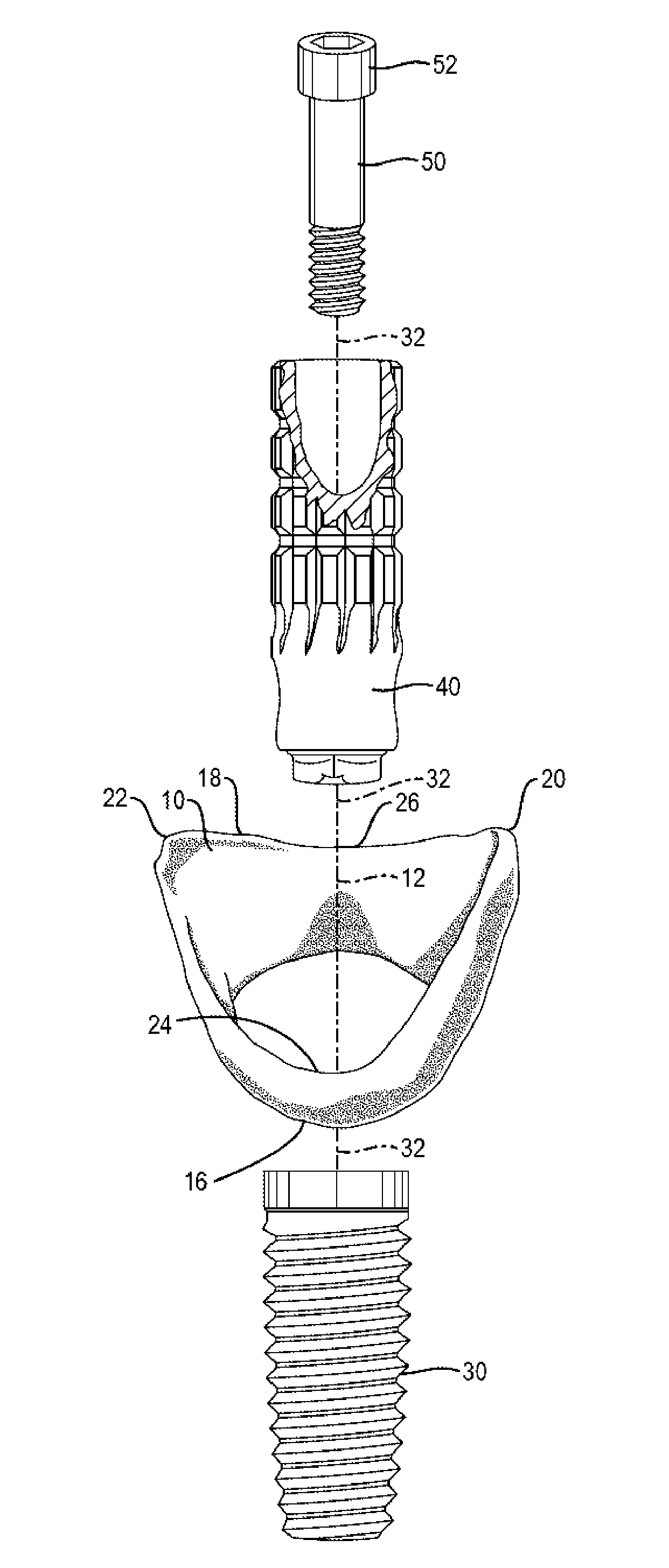 Soft tissue preservation temporary (shell) immediate-implant abutment with biological active surface