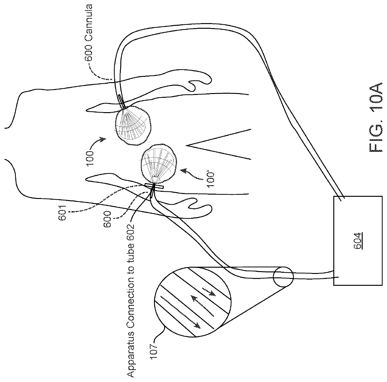Apparatuses and methods for improving recovery from minimally invasive surgery