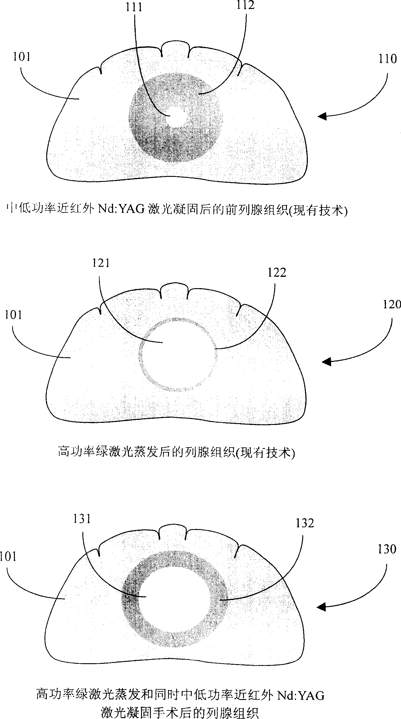 Fixed laser soft tissue therapeutic apparatus of double wavelength continuous pumping and method therefor