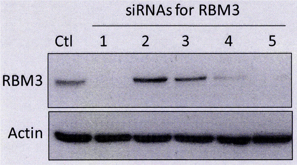 siRNA capable of inhibiting RBM3 gene expression of human melanoma and plasmid vector of siRNA