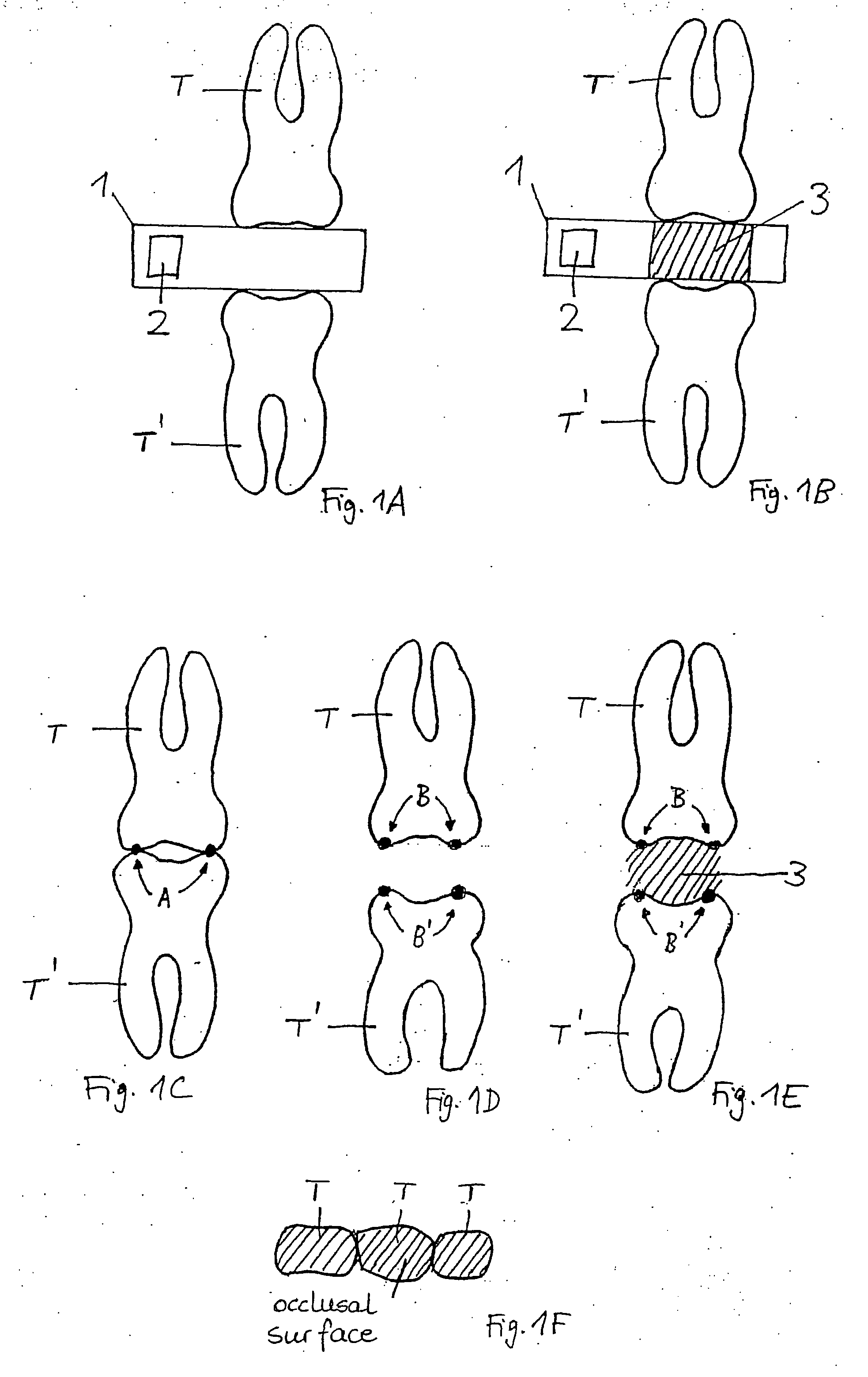 Device for indirectly measuring occlusal forces