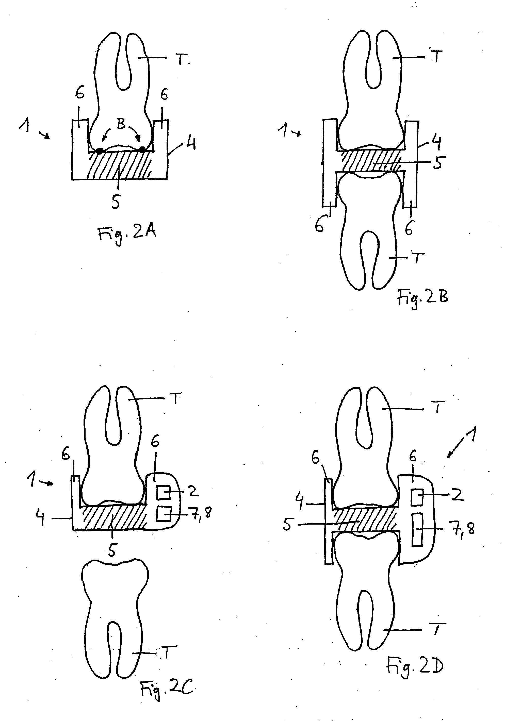 Device for indirectly measuring occlusal forces