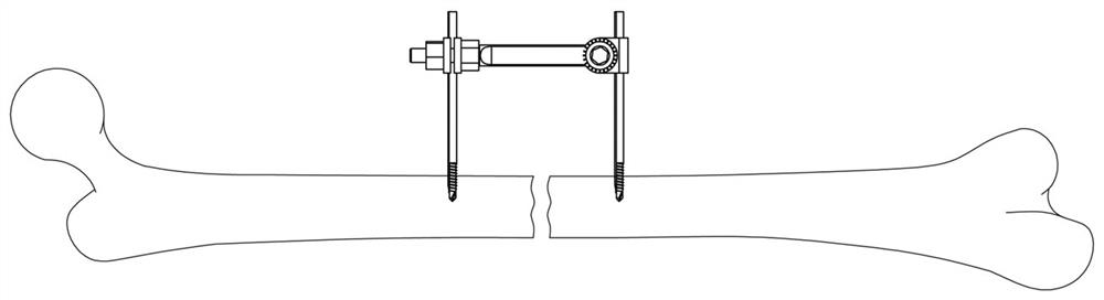 Single-rod double-nail external fixing frame