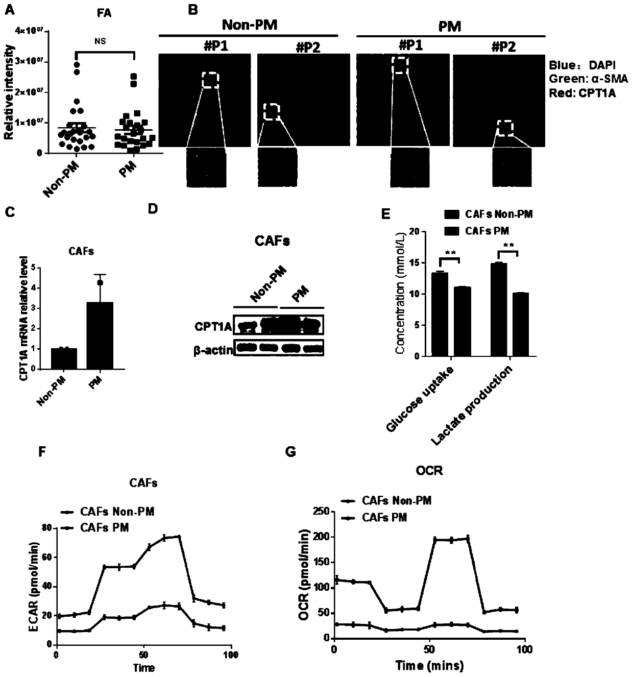 Application of fatty acid oxidation inhibitor in preparing medicine for treating colorectal cancer