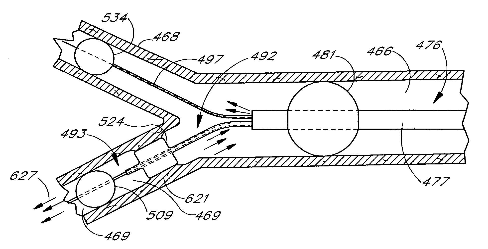 Method and apparatus for emboli containment