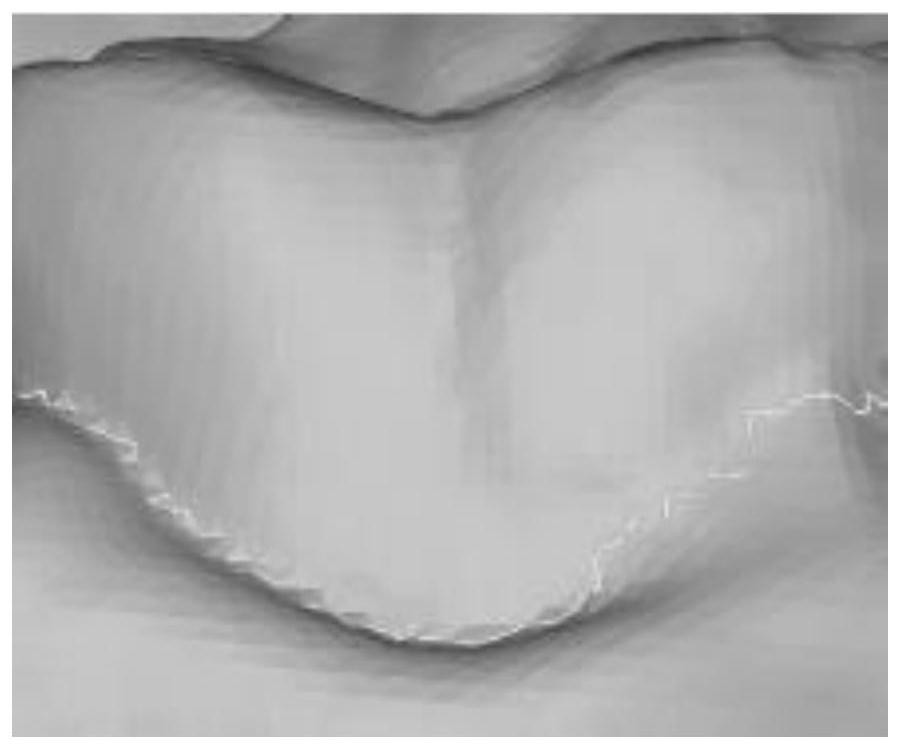 A 3D Dental Model Segmentation Method for Computer-Aided Invisible Orthodontics