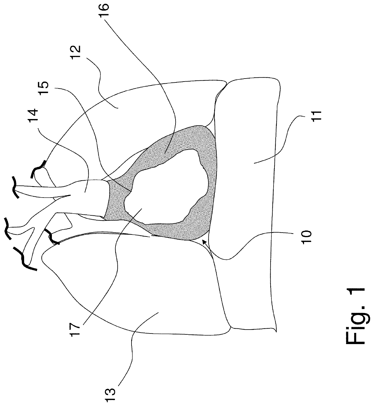 Shaped epicardial lead and placement system and method