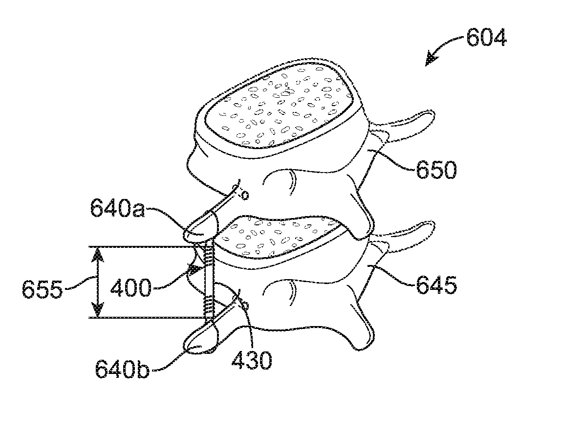 Method for preventing vertebra displacement after spinal fusion surgery