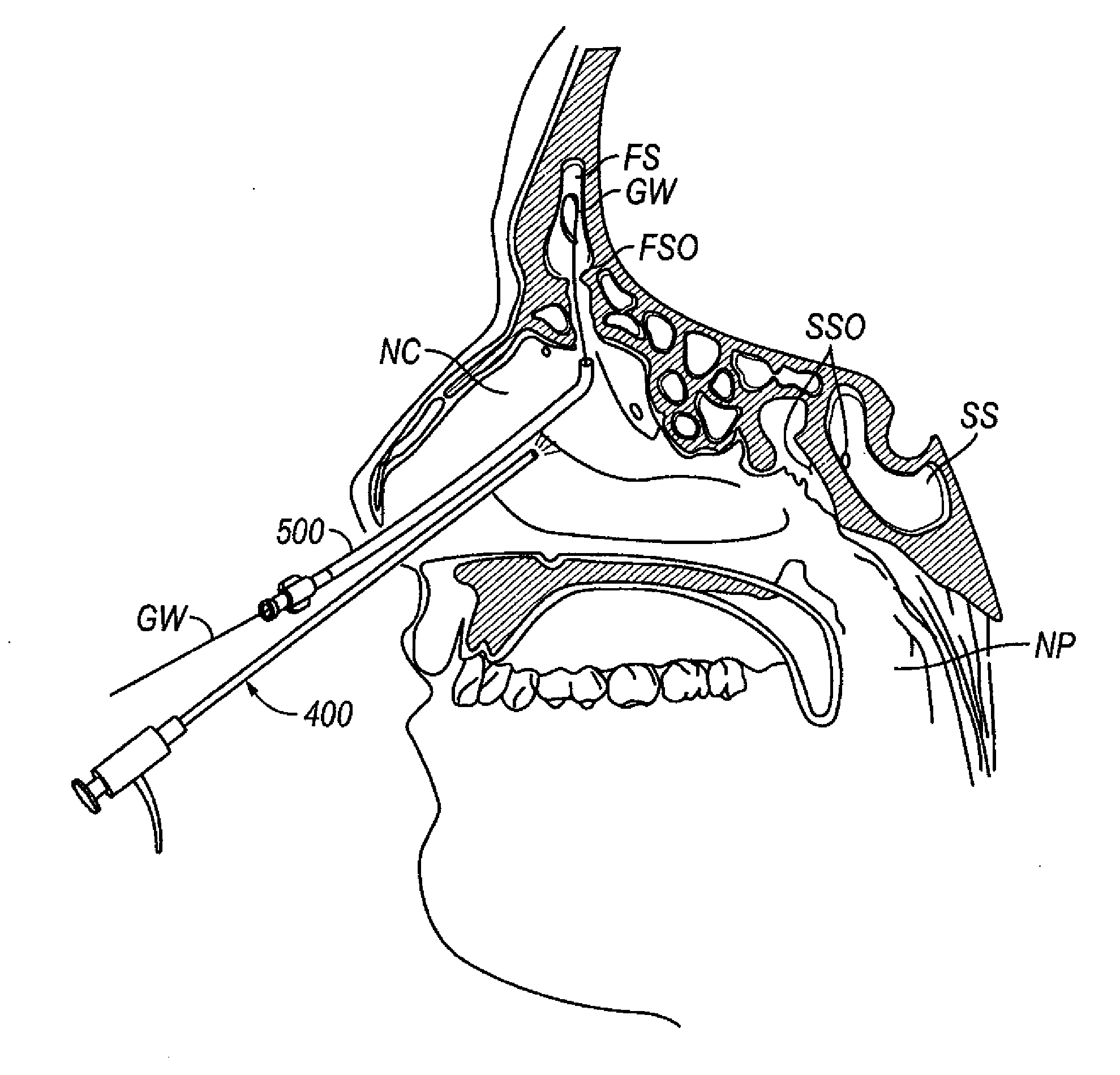 Ethmoidotomy System and Implantable Spacer Devices Having Therapeutic Substance Delivery Capability for Treatment of Paranasal Sinusitis