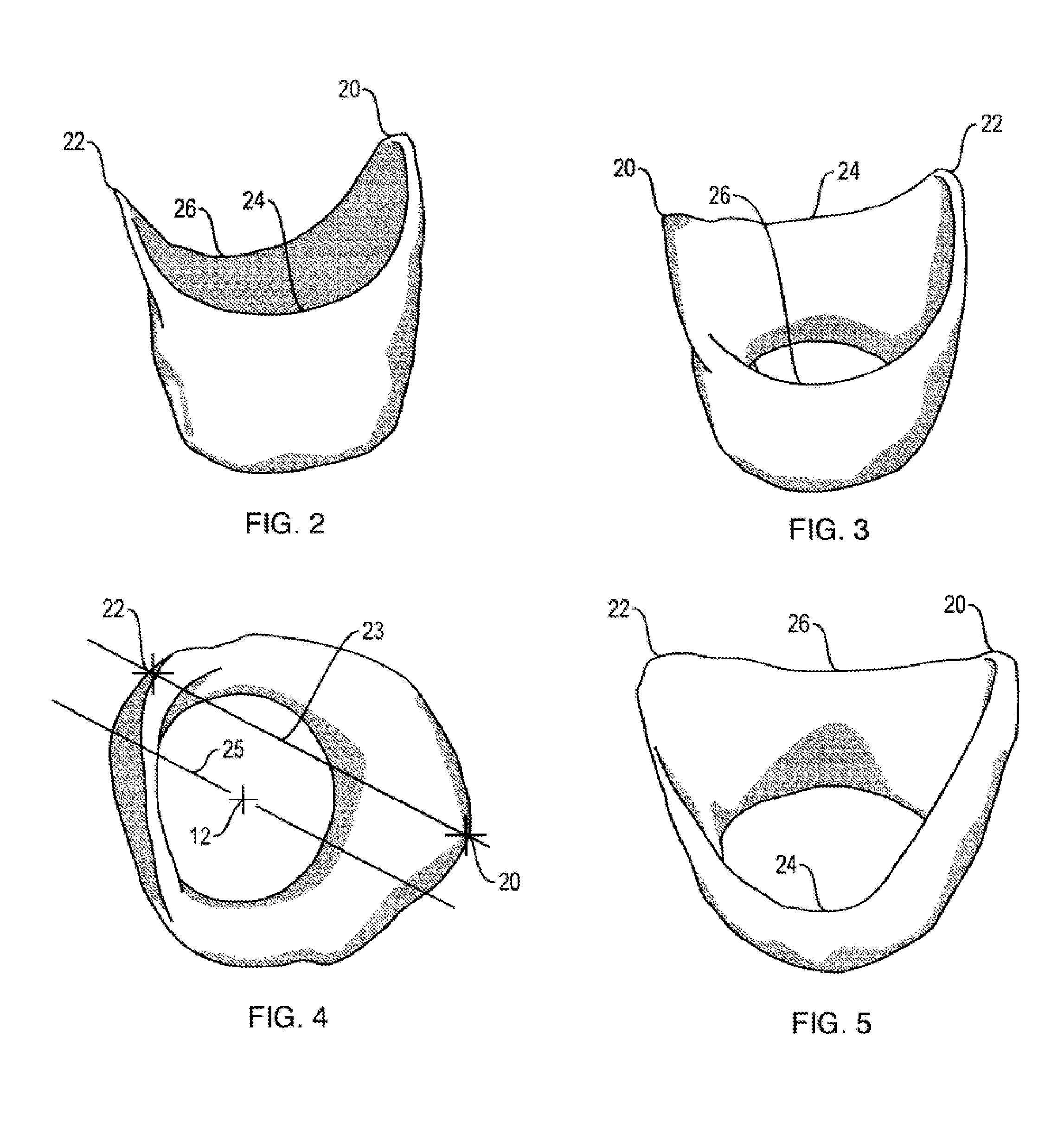 Method and apparatus for recording spatial gingival soft tissue relationship to implant placement within alveolar bone for immediate-implant placement
