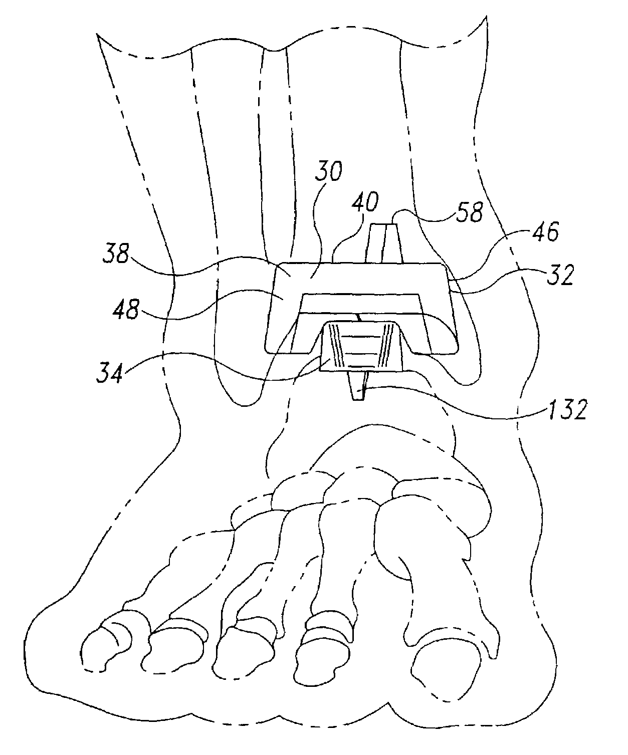Ankle prosthesis with a front loading bearing and associated method