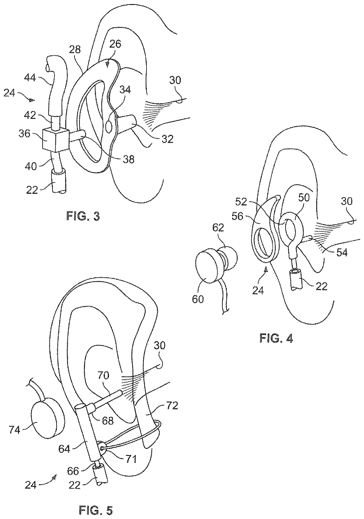 In-ear noise dosimeter