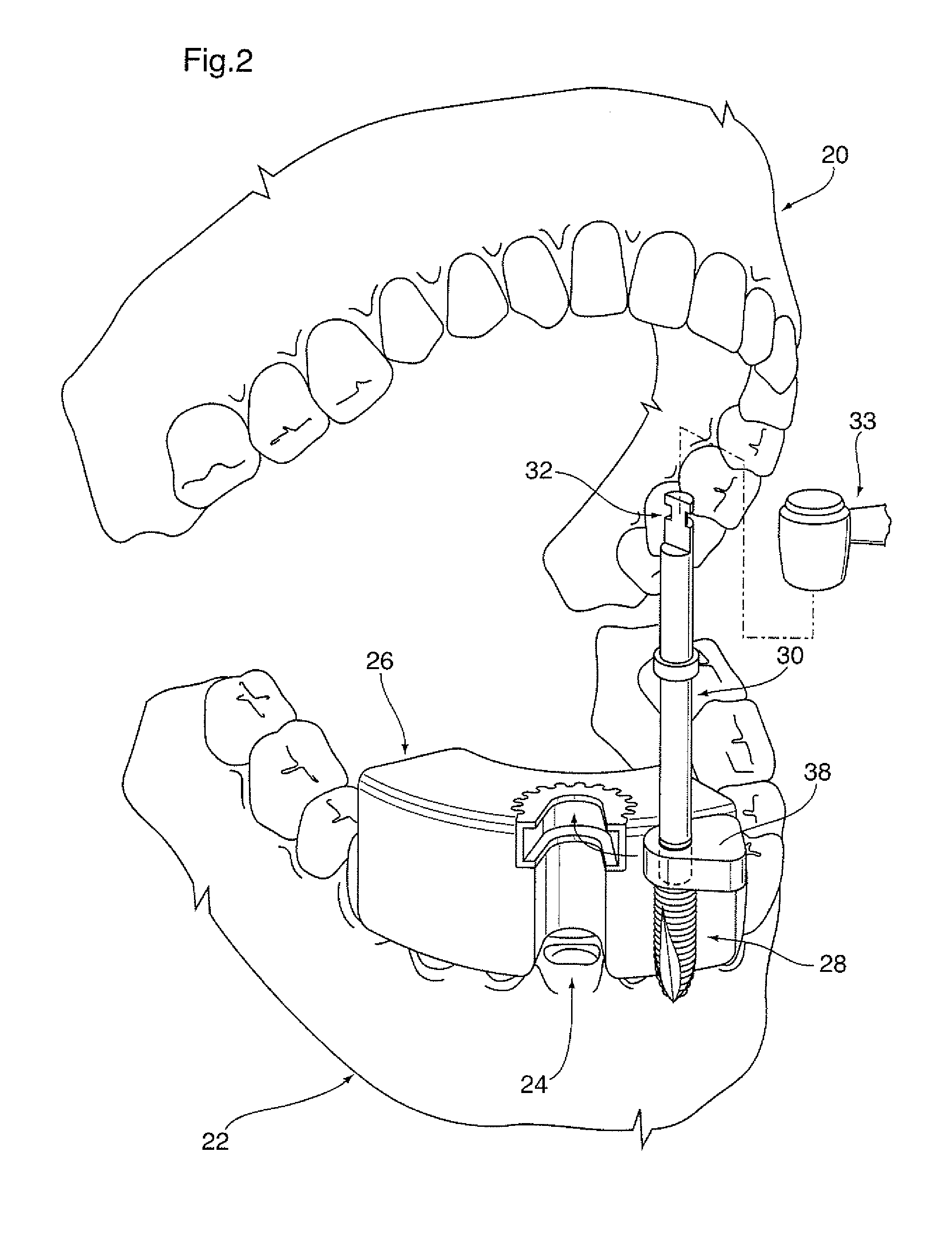 Dental implant positioning system
