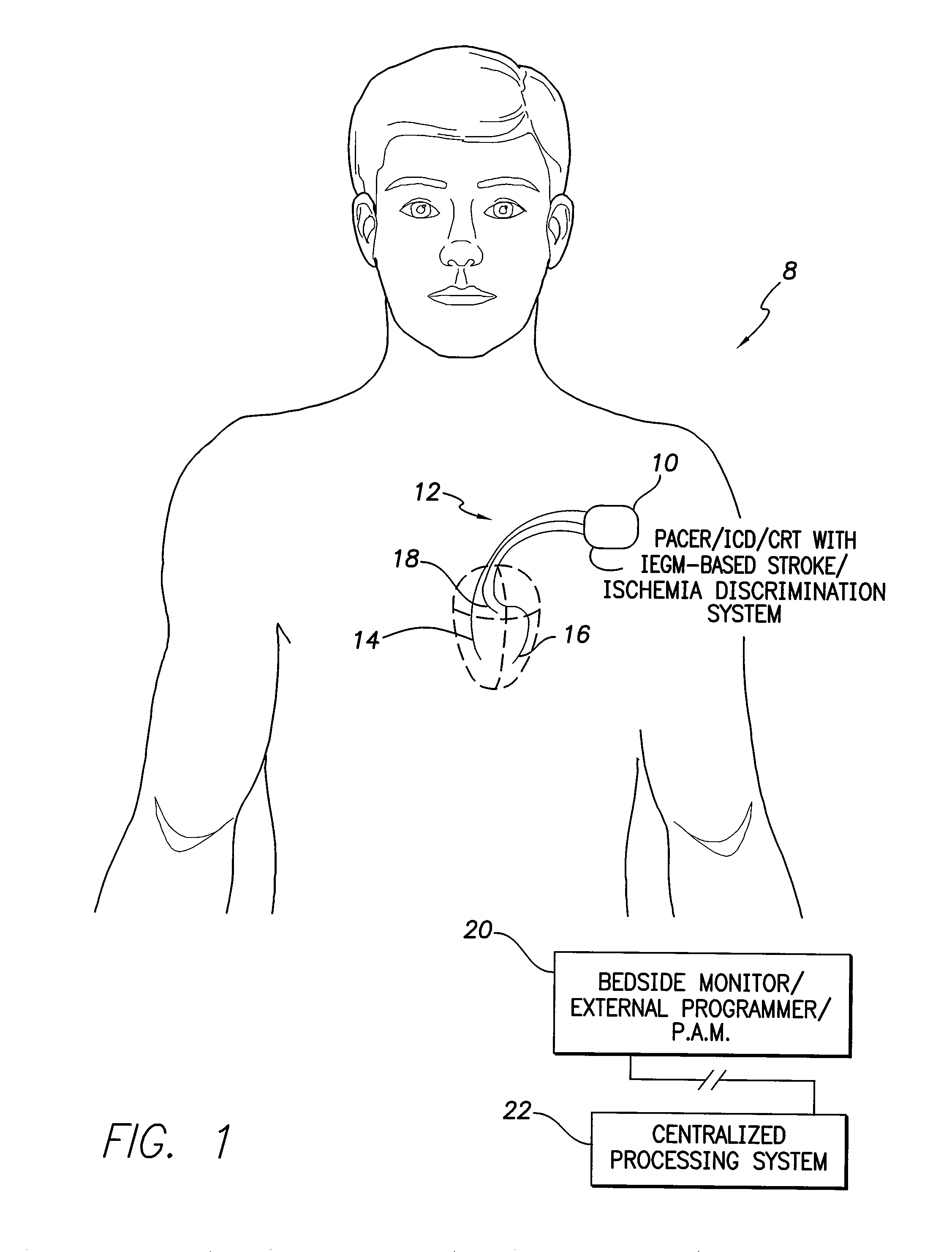 Systems and methods for use by implantable medical devices for detecting and discriminating stroke and cardiac ischemia using electrocardiac signals