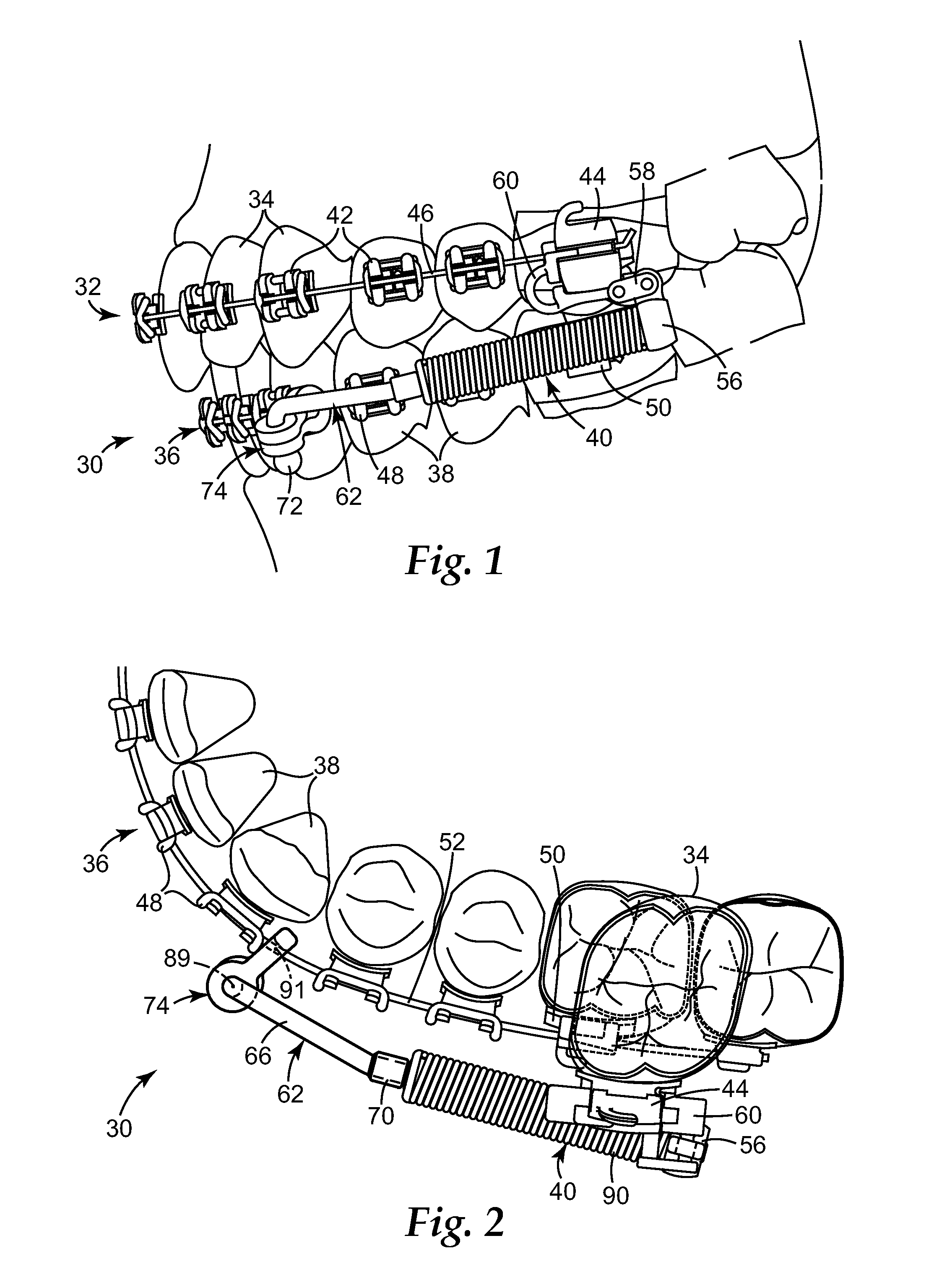 Interarch force module with link for orthodontic treatment