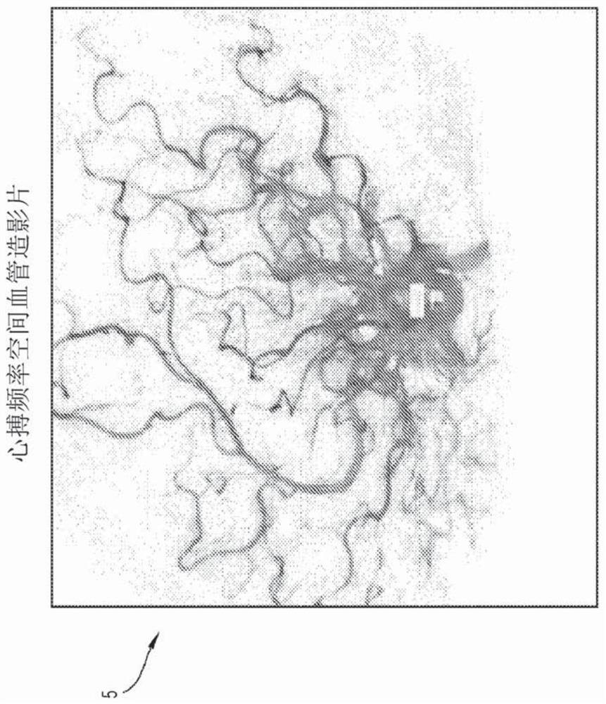 Spatiotemporal reconstruction of a moving vascular pulse wave from a plurality of lower dimensional angiographic projections