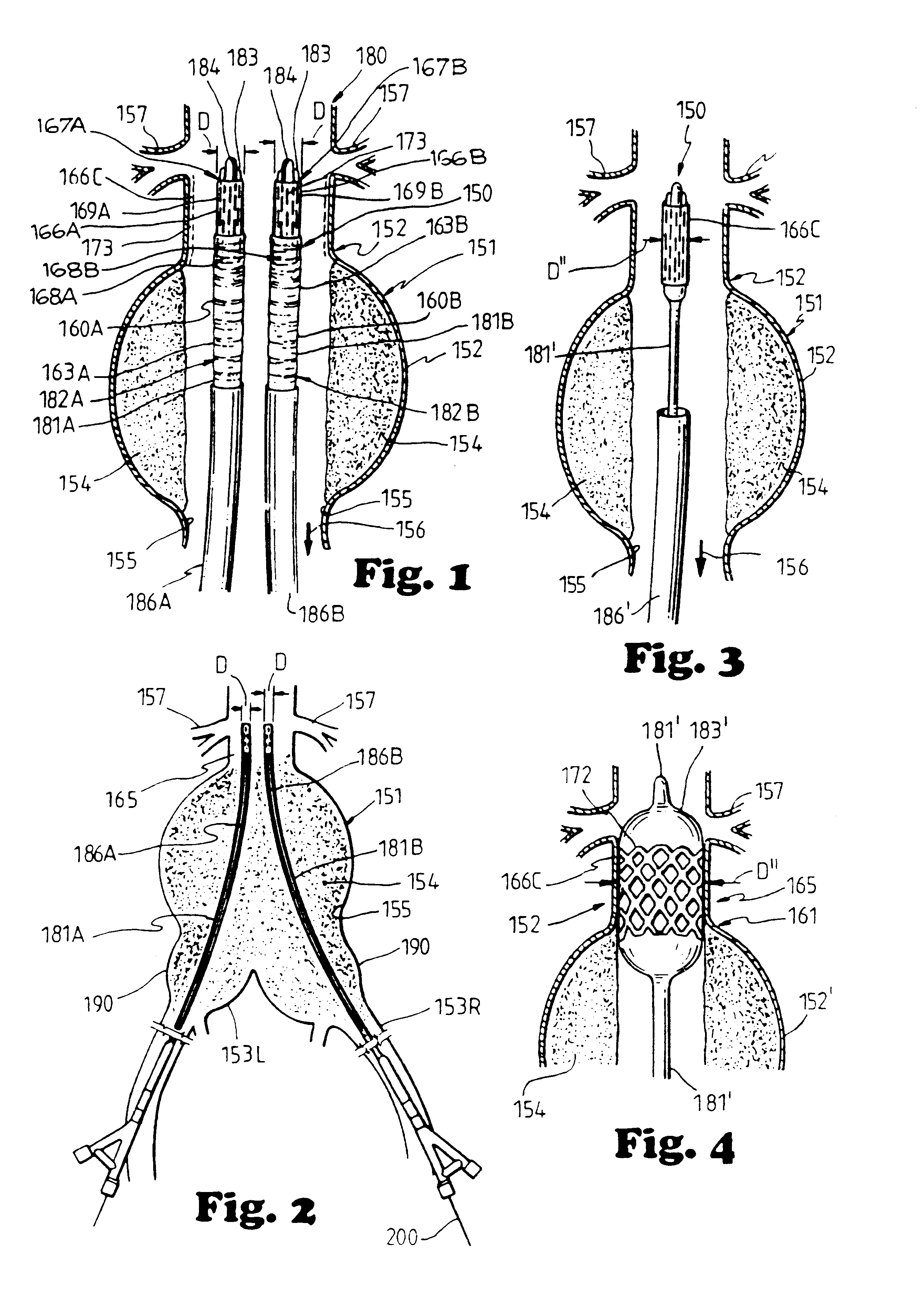 Method and apparatus for bilateral intra-aortic bypass