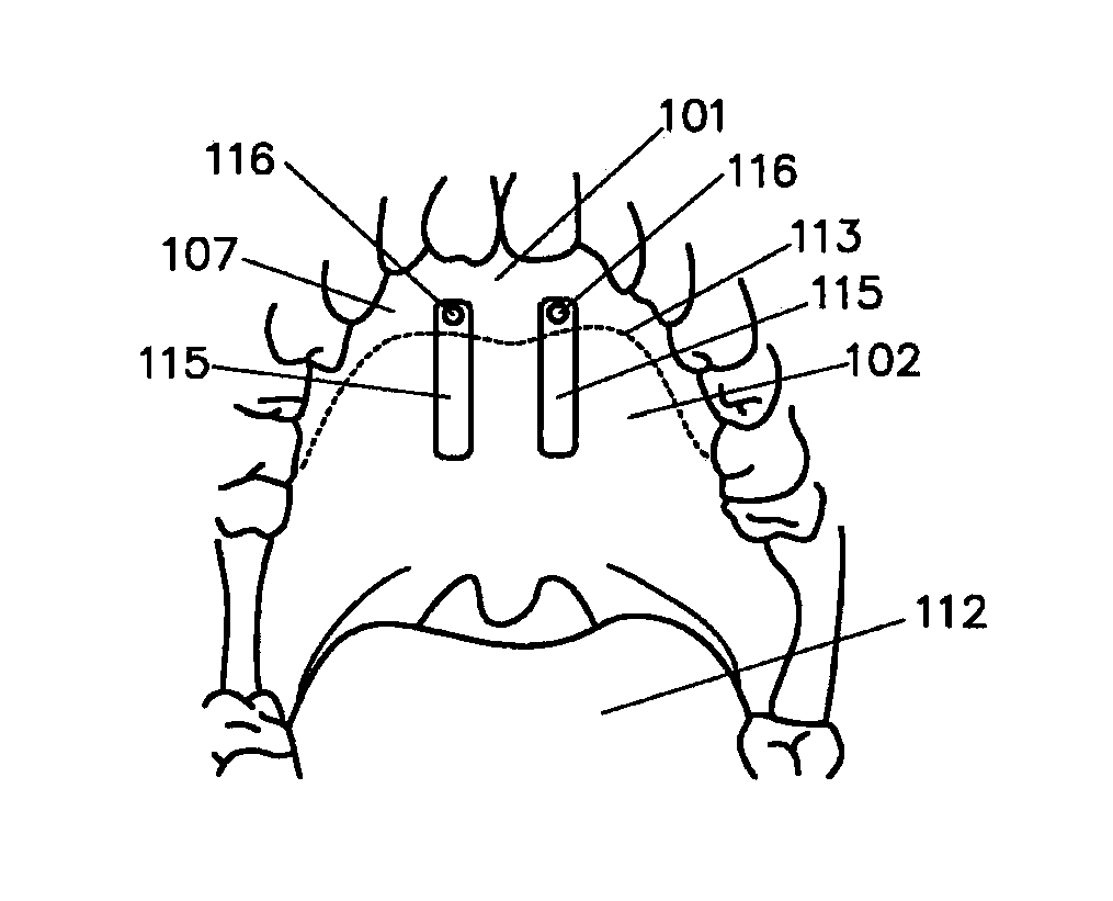 Implanted Soft Palate Support and Implantation Method