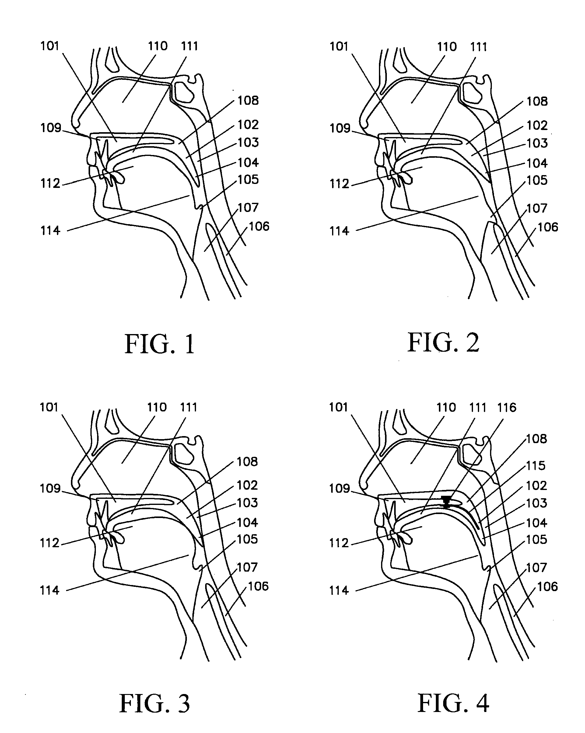 Implanted Soft Palate Support and Implantation Method