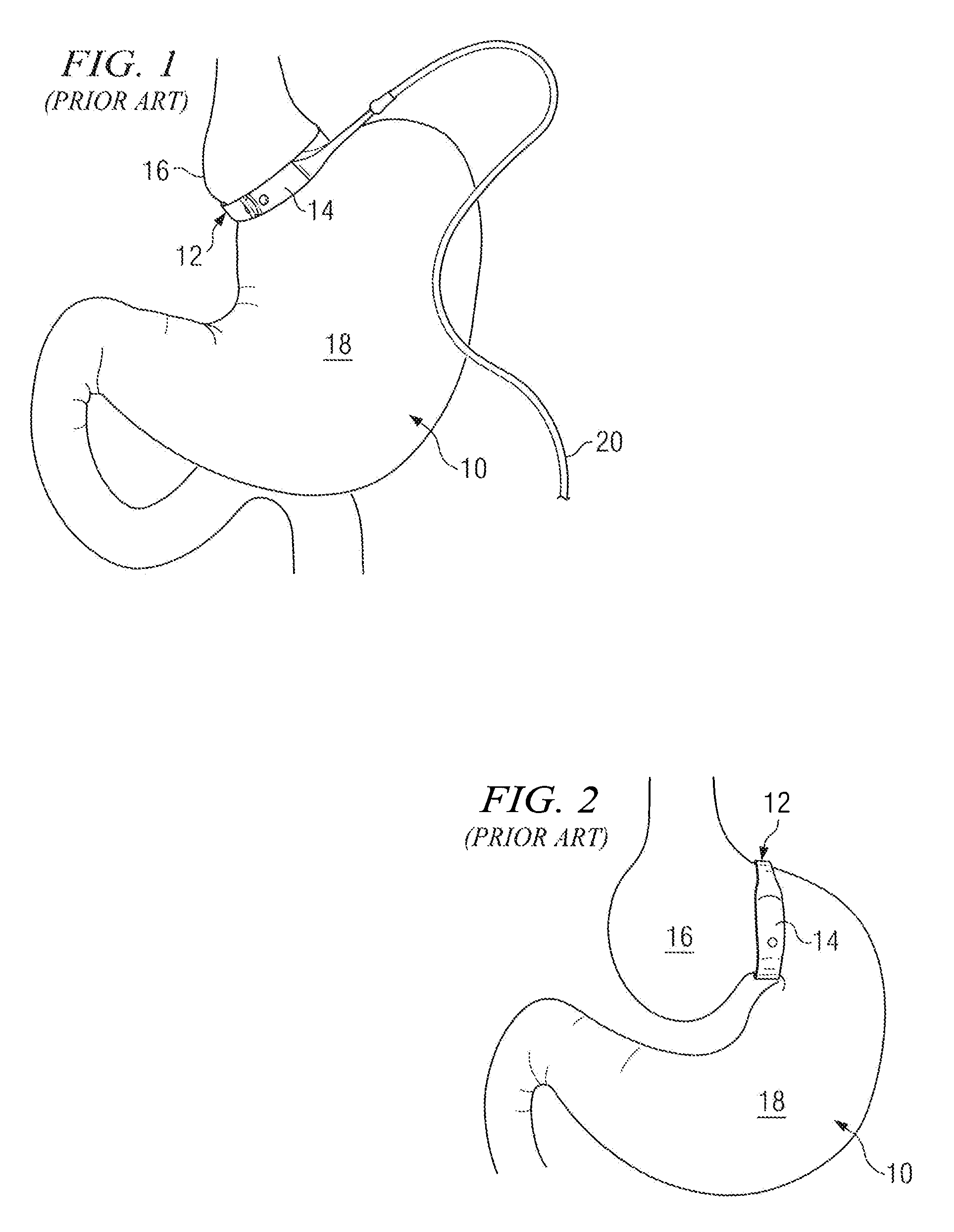 Method of and apparatus for prevention of adjustable gastric band slips