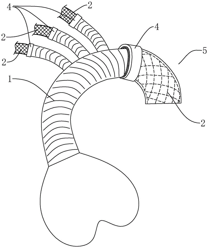 Artificial blood vessel and covered stent connection mechanism for aortic operation