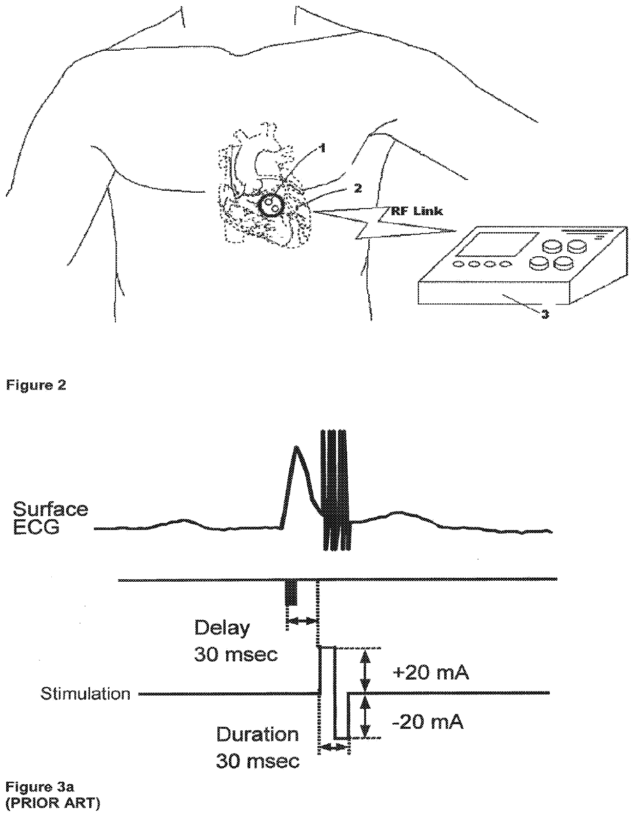Methods and systems for heart failure prevention and treatments using ultrasound and leadless implantable devices