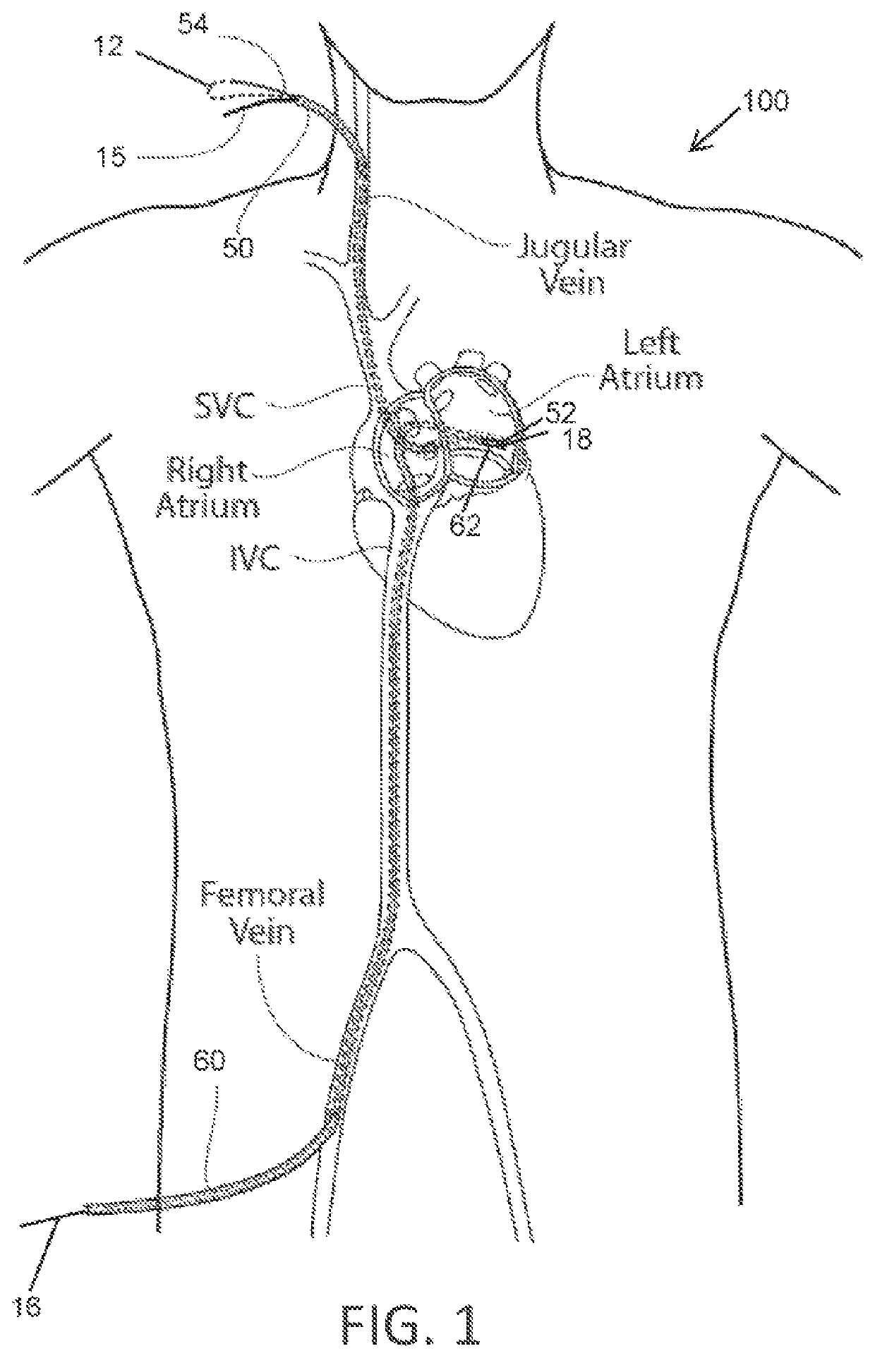 Delivery system and methods for reshaping a heart valve annulus, including the use of magnetic tools