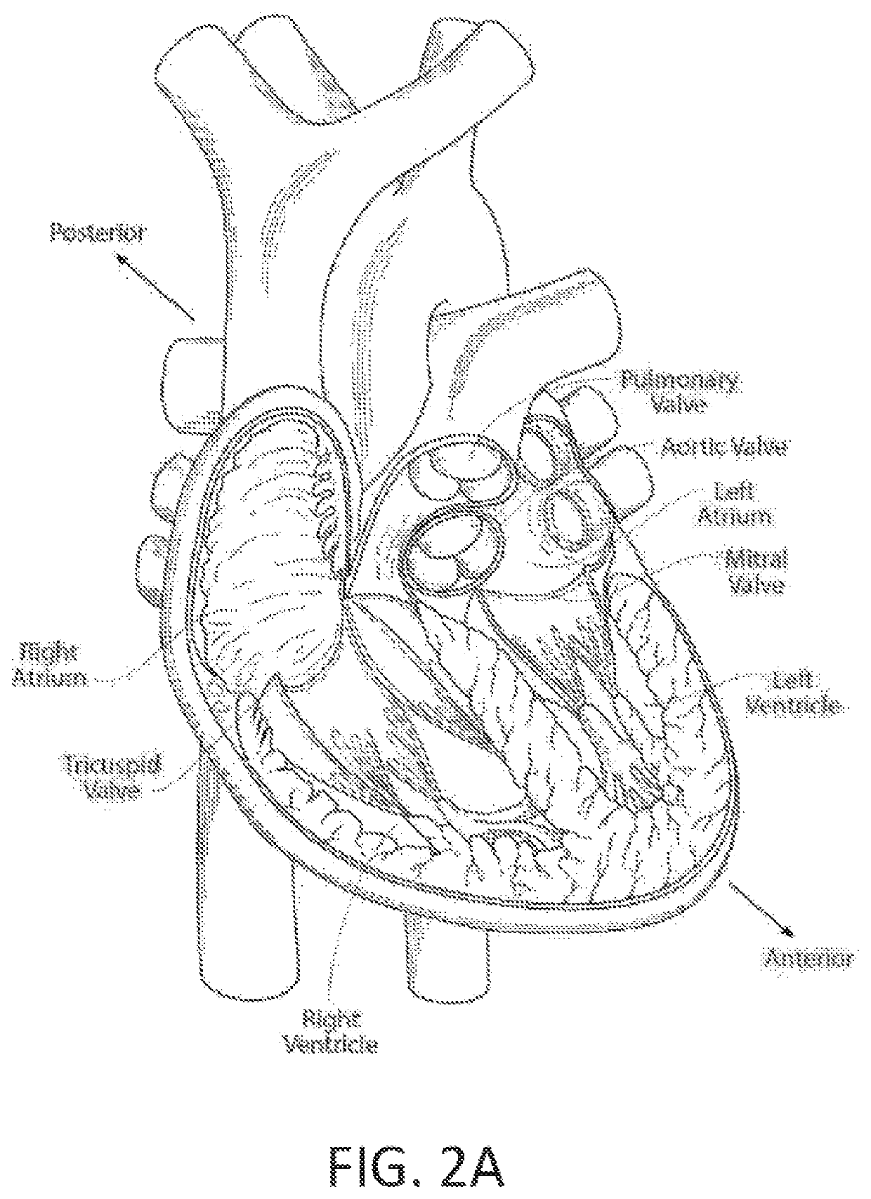 Delivery system and methods for reshaping a heart valve annulus, including the use of magnetic tools