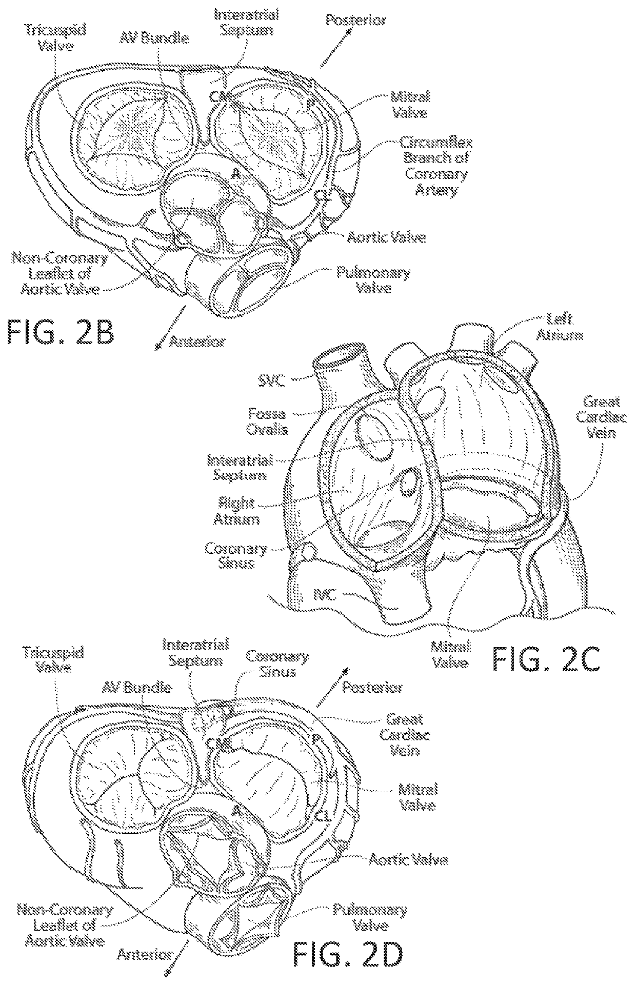 Delivery system and methods for reshaping a heart valve annulus, including the use of magnetic tools