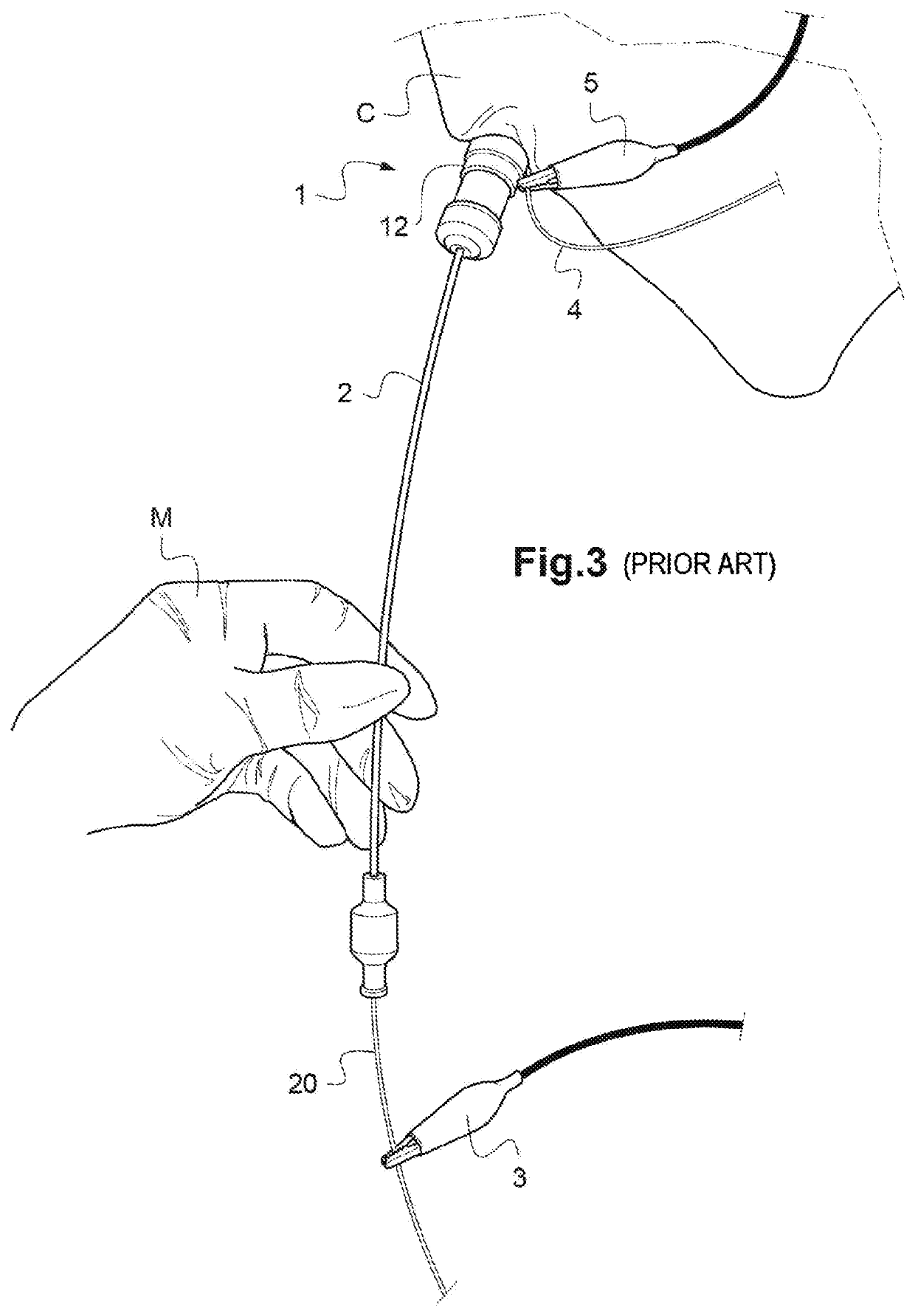 Assembly for placement of a cardiac, aortic or arterial implant with stimulation assistance by a peripheral venous or arterial catheter