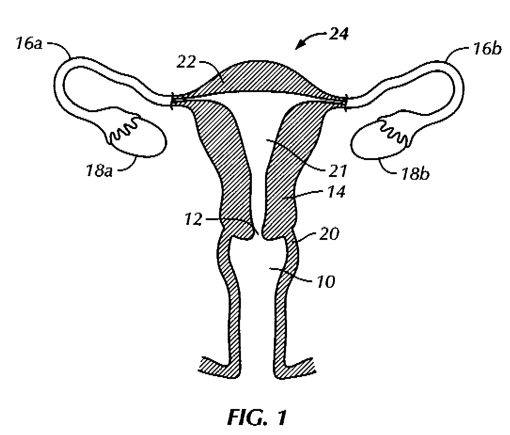 Methods and apparatus for natural orifice vaginal hysterectomy
