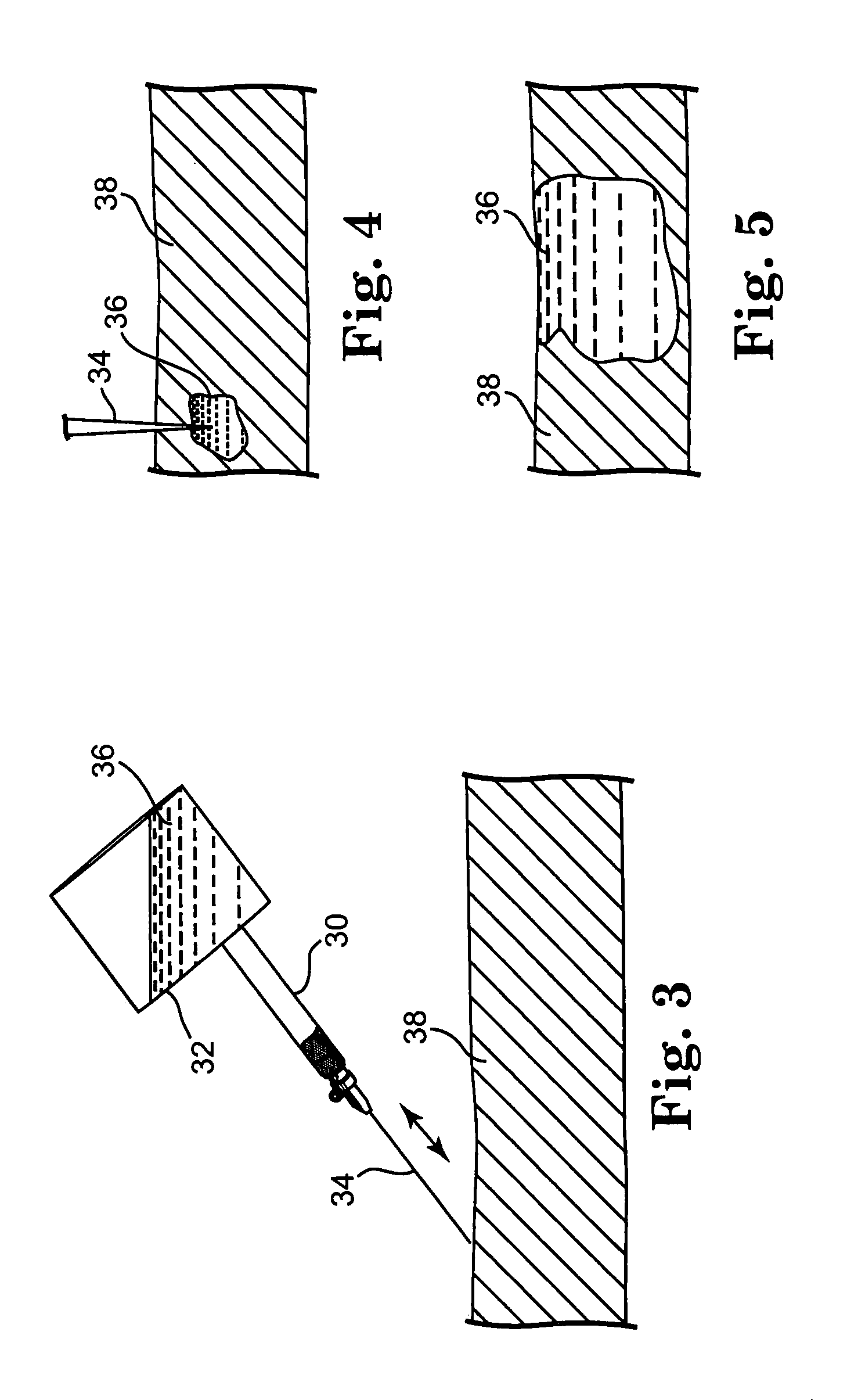 Device and method for ablation of cardiac tissue