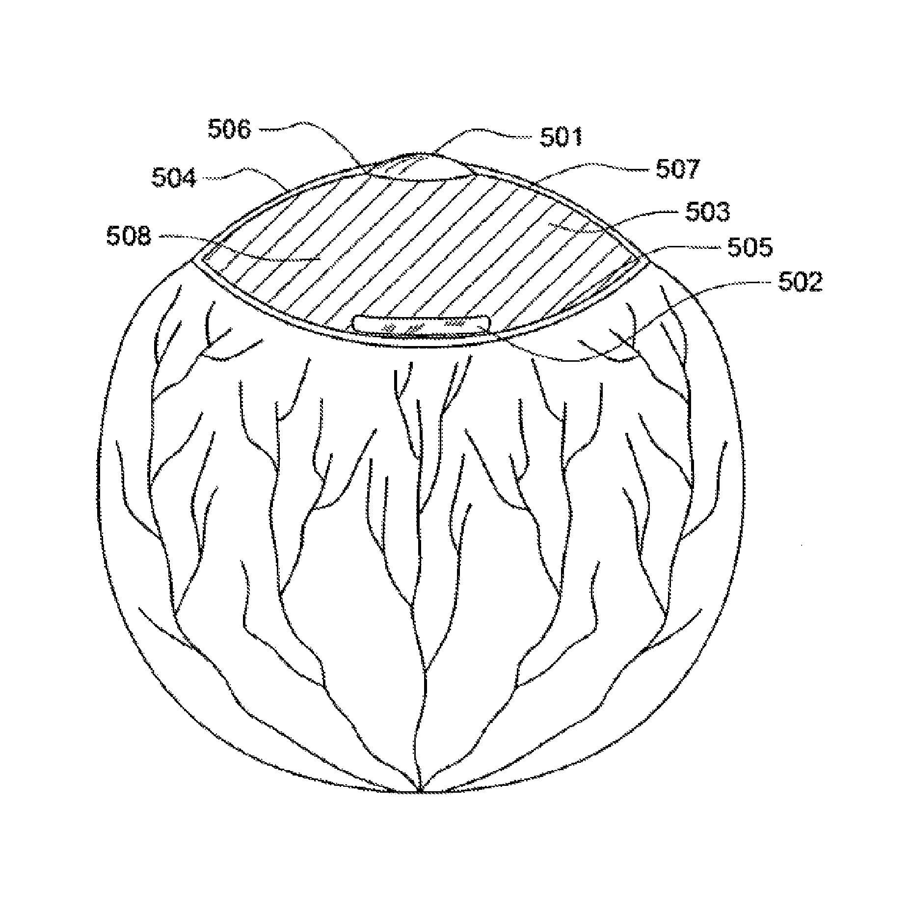 Intraocular lens system with injectable accommodation material