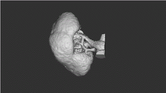 3D kidney model printing method for kidney stone surgical simulation teaching