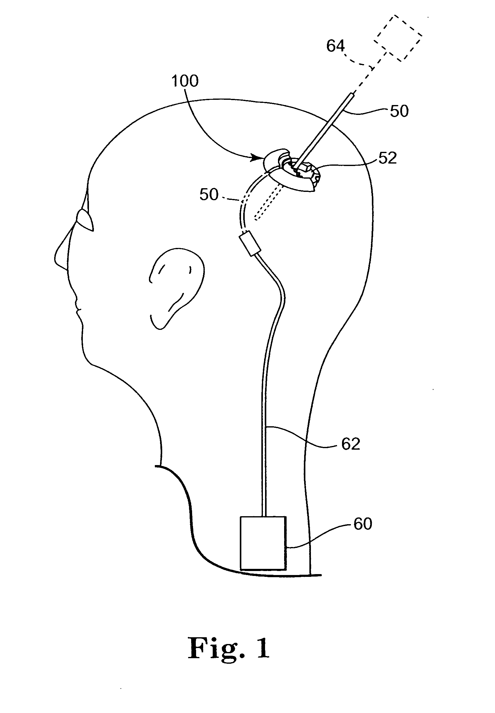 Low profile apparatus for securing a therapy delivery device within a burr hole