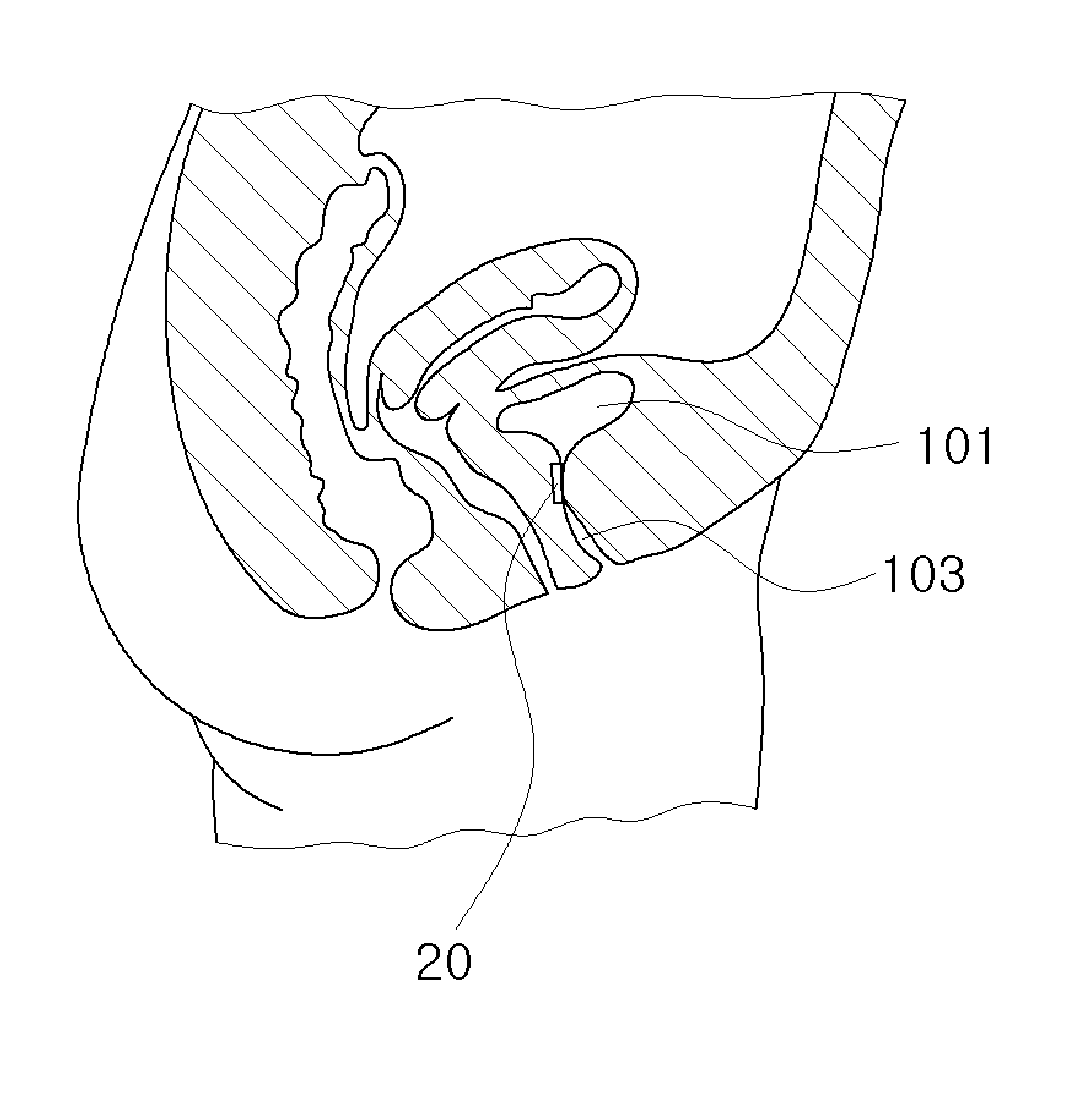 Pressure-to-tension conversion device for treating urinary incontinence