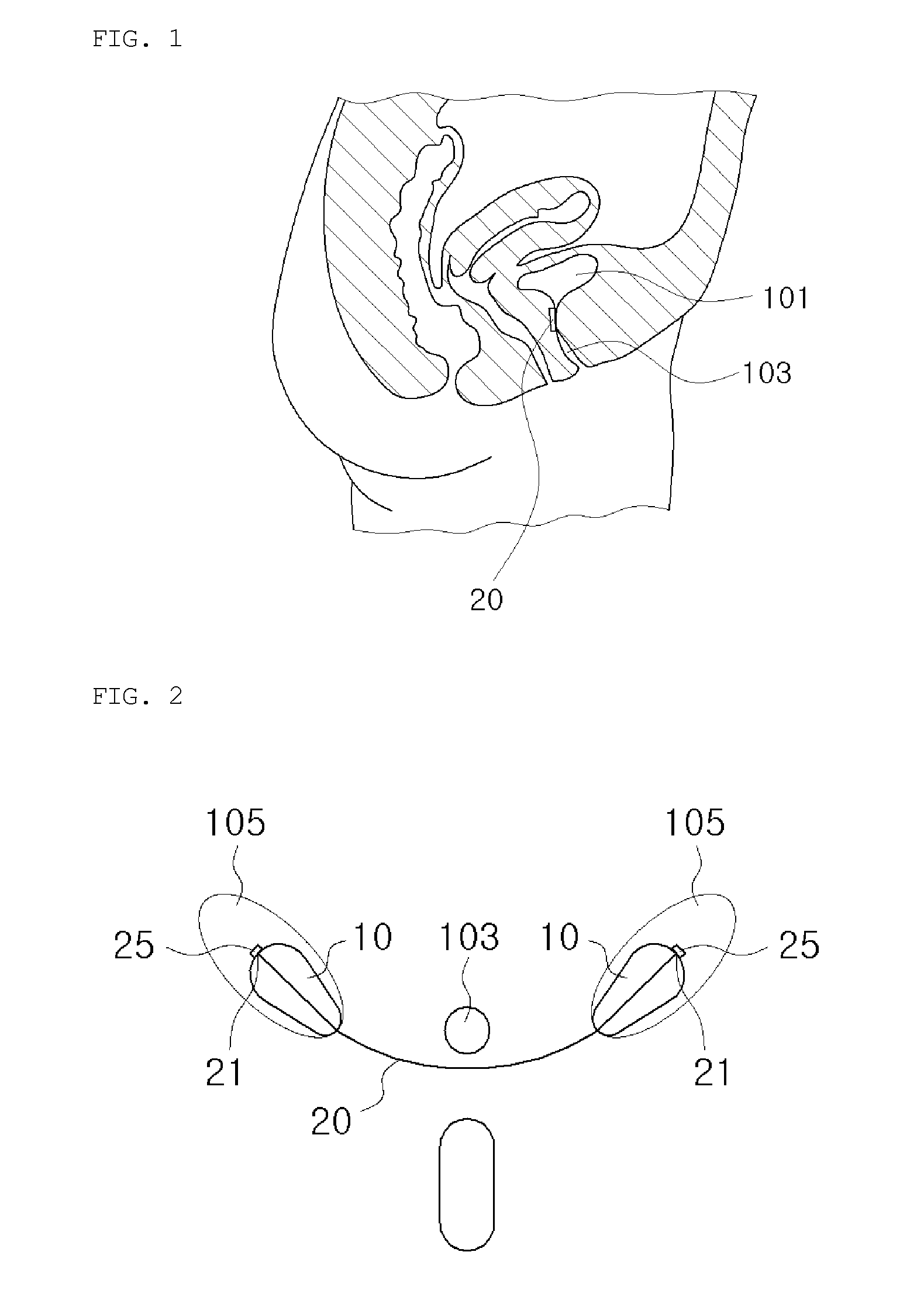 Pressure-to-tension conversion device for treating urinary incontinence