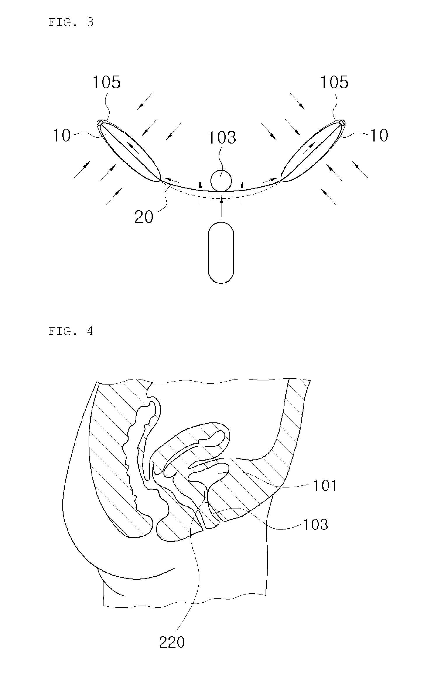 Pressure-to-tension conversion device for treating urinary incontinence