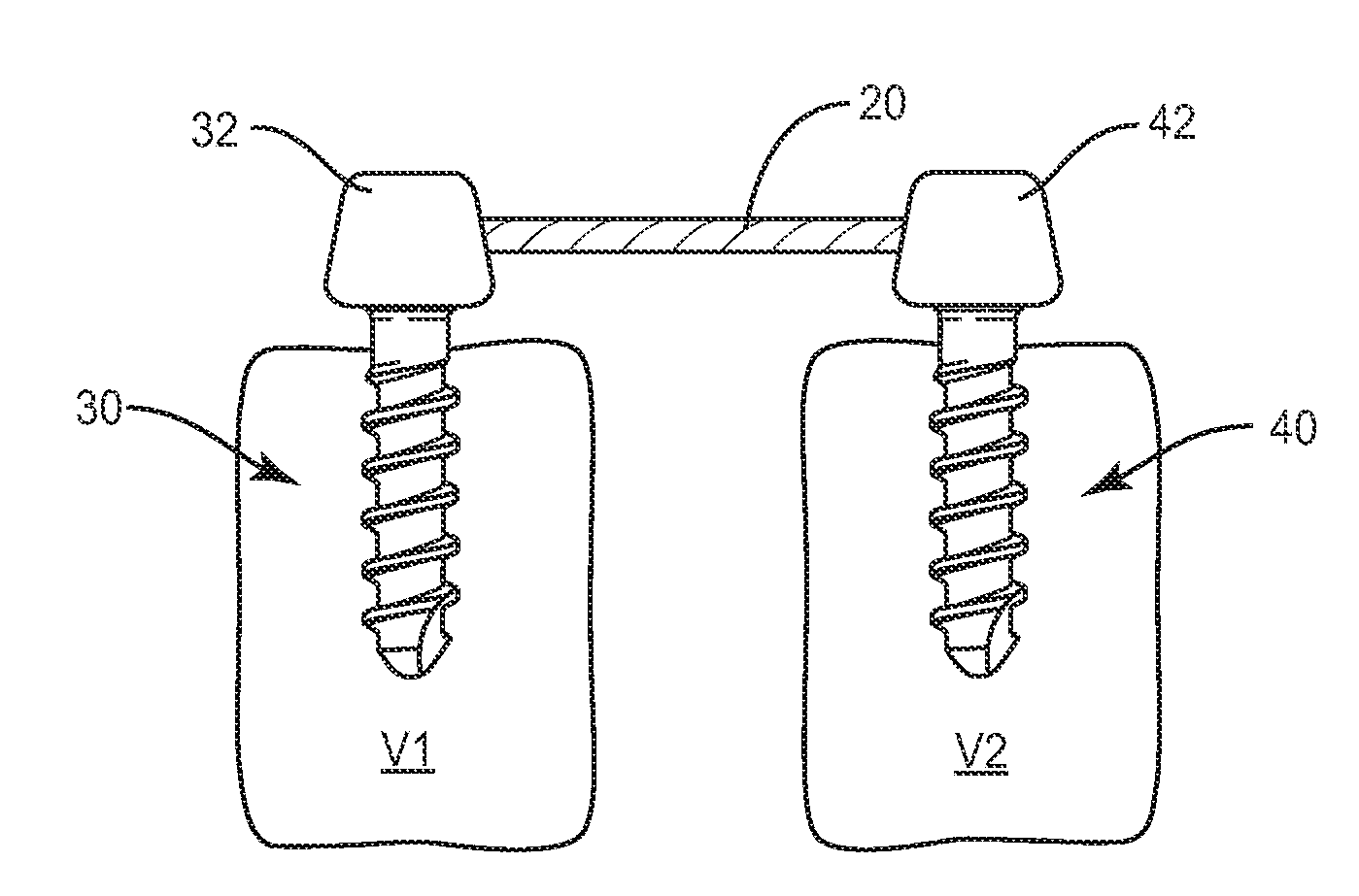 Spinal systems and methods for correction of spinal disorders
