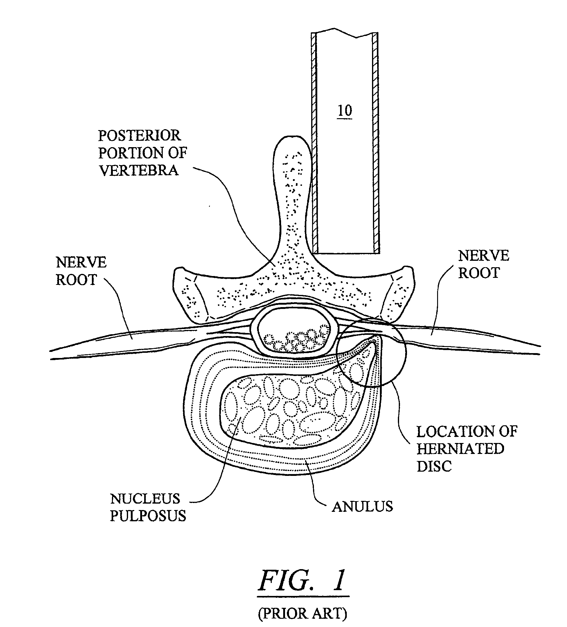 Configured and sized cannula