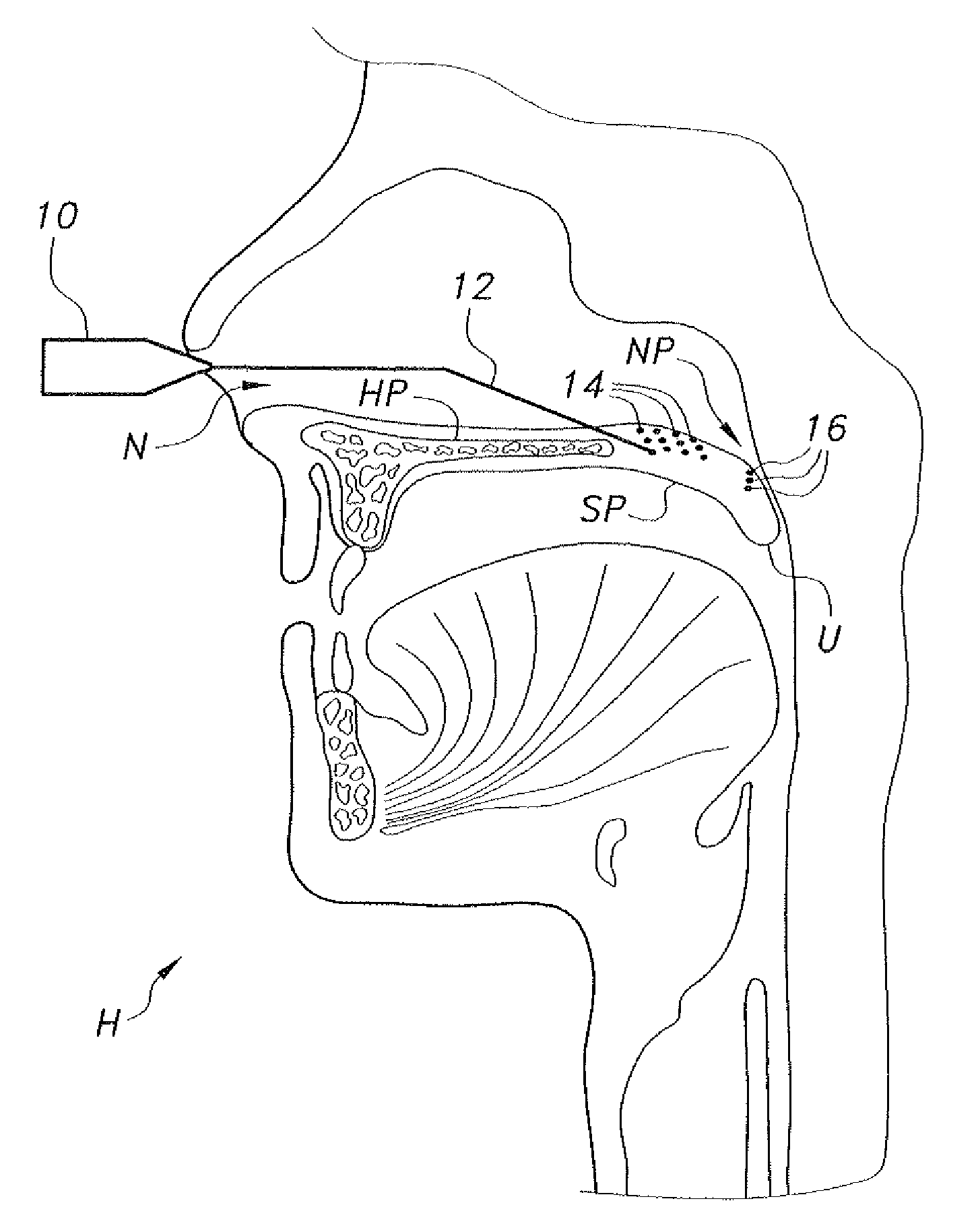 Endoscopic nasal palatoplasty