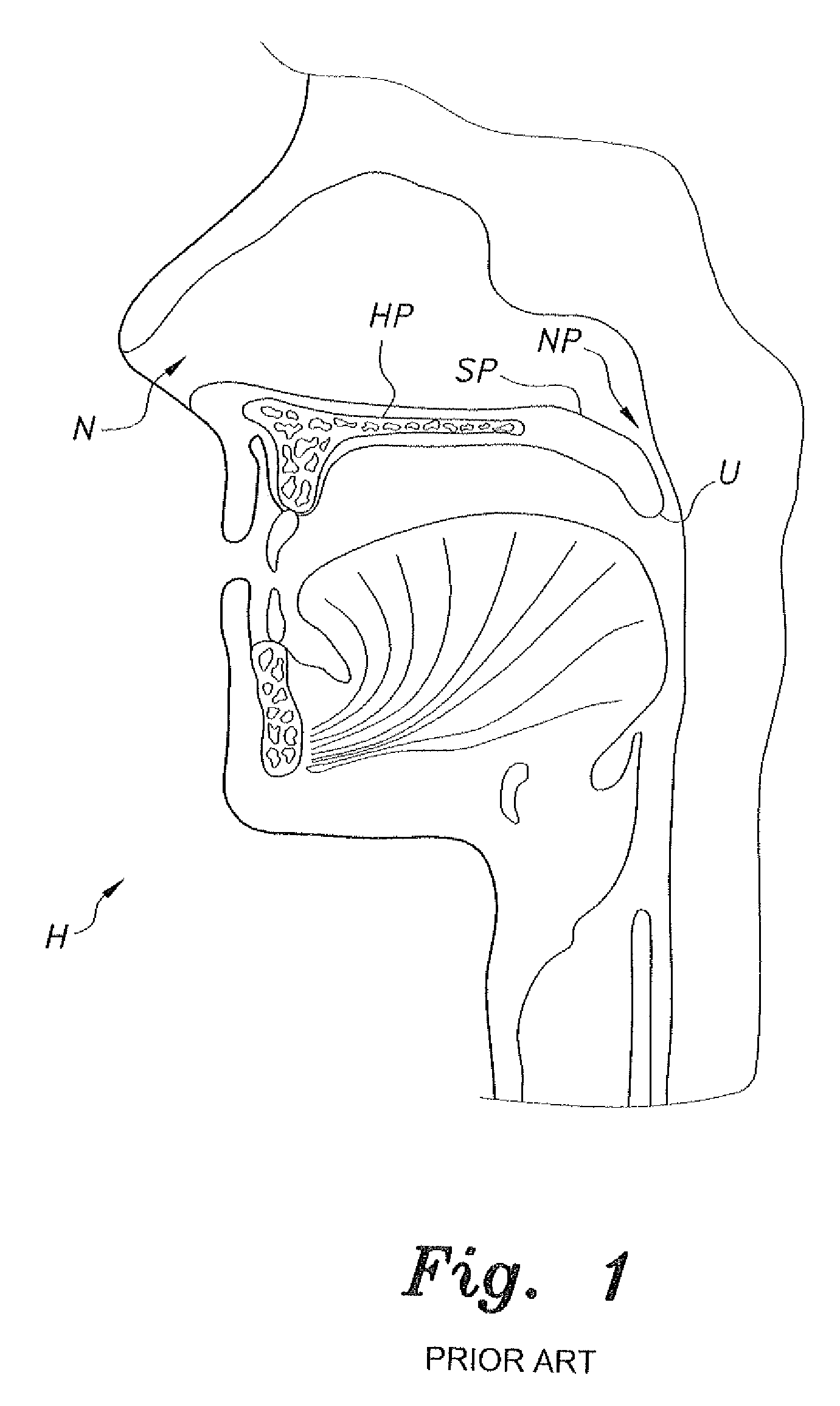 Endoscopic nasal palatoplasty