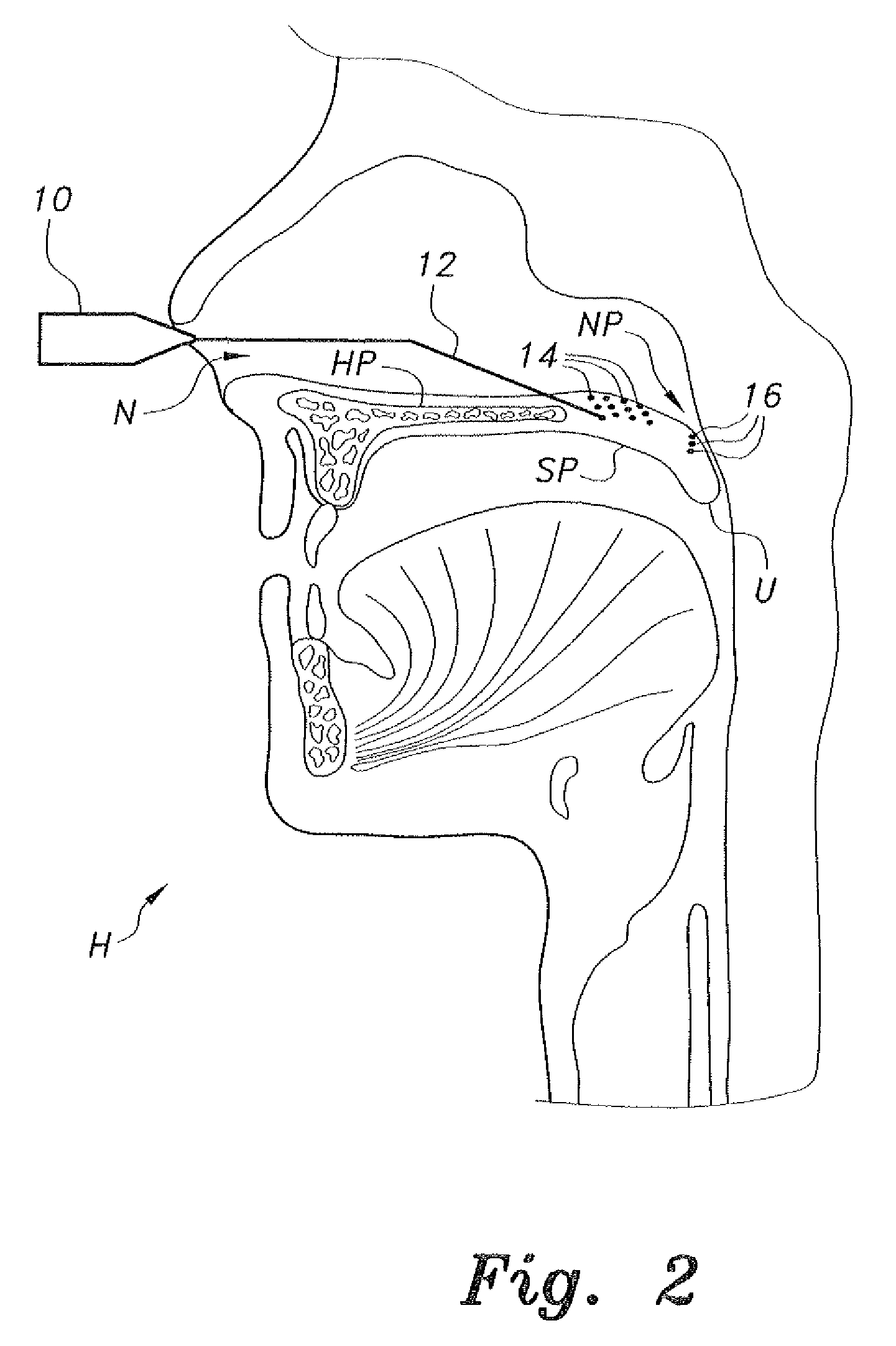 Endoscopic nasal palatoplasty