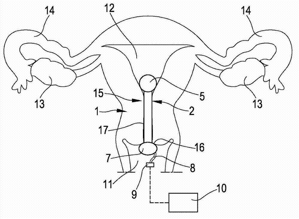 Therapeutic agent, composition including said agent, implantable device and process for the treatment of cervical cancer and/or for the prevention of the formation of neoplasms in correspondence of the cervix in a human female genital system