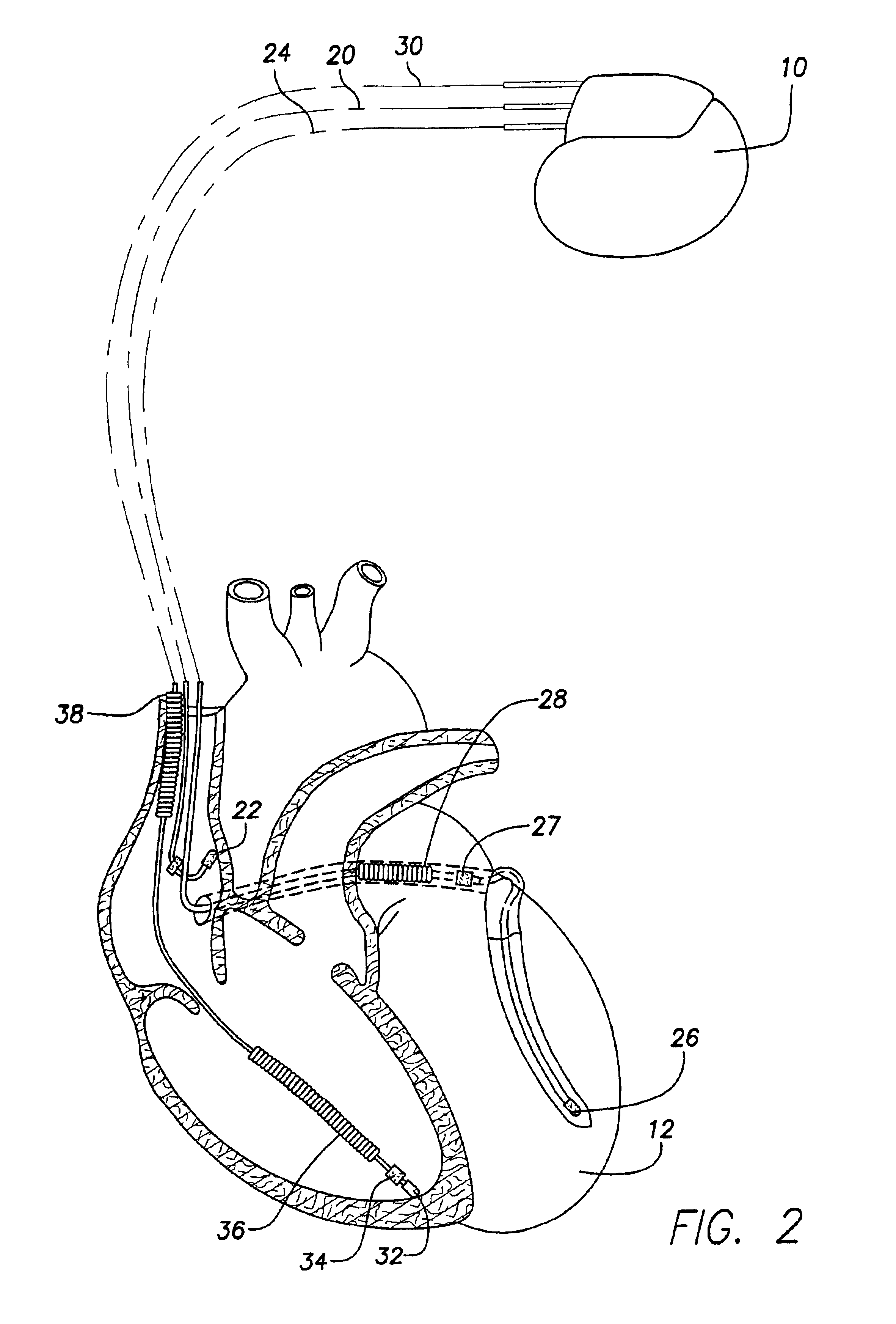 Method and apparatus for dynamically adjusting overdrive pacing parameters