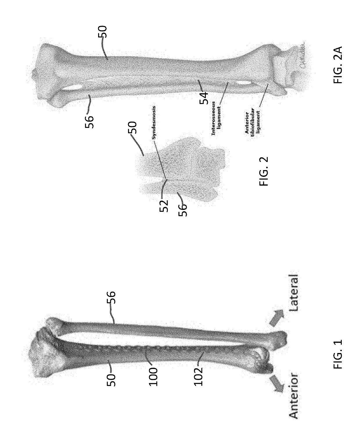 Distal tibial plating system