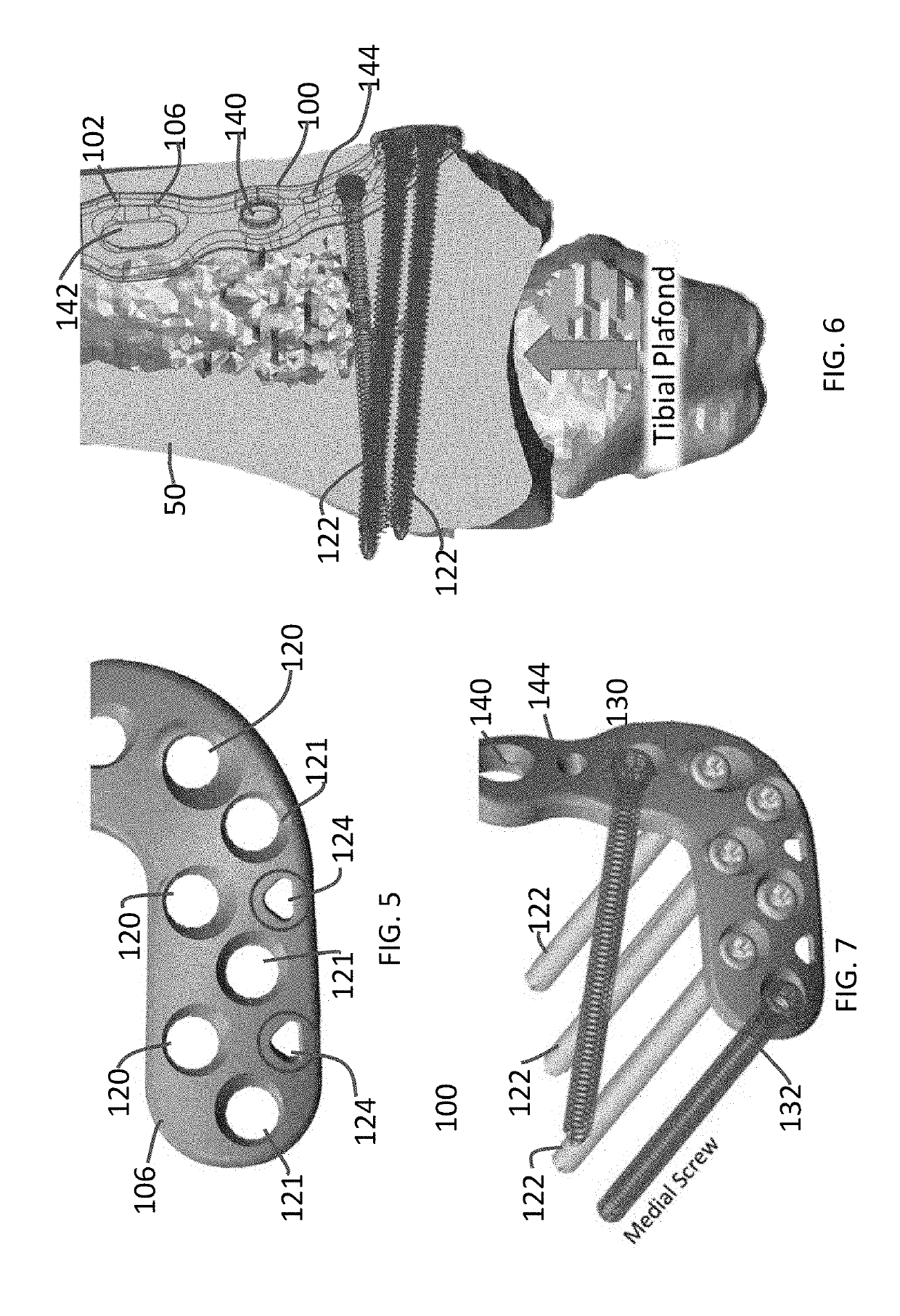 Distal tibial plating system