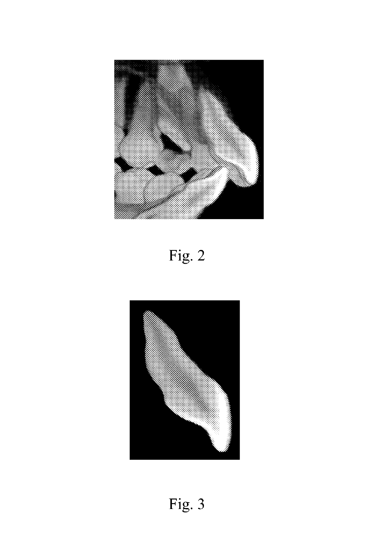 Dental treatment method and abutment used therein