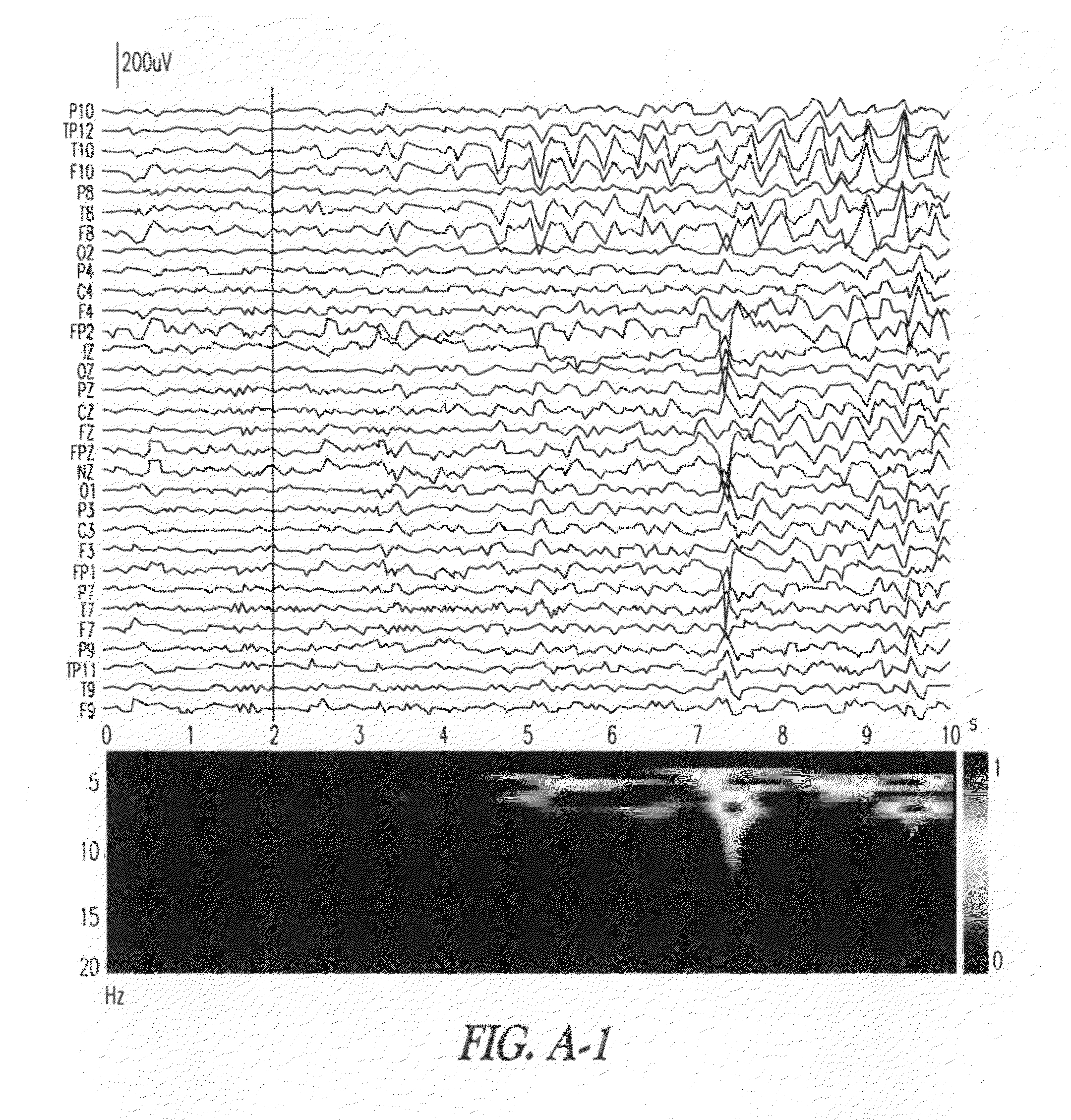 System and method for ictal source analysis